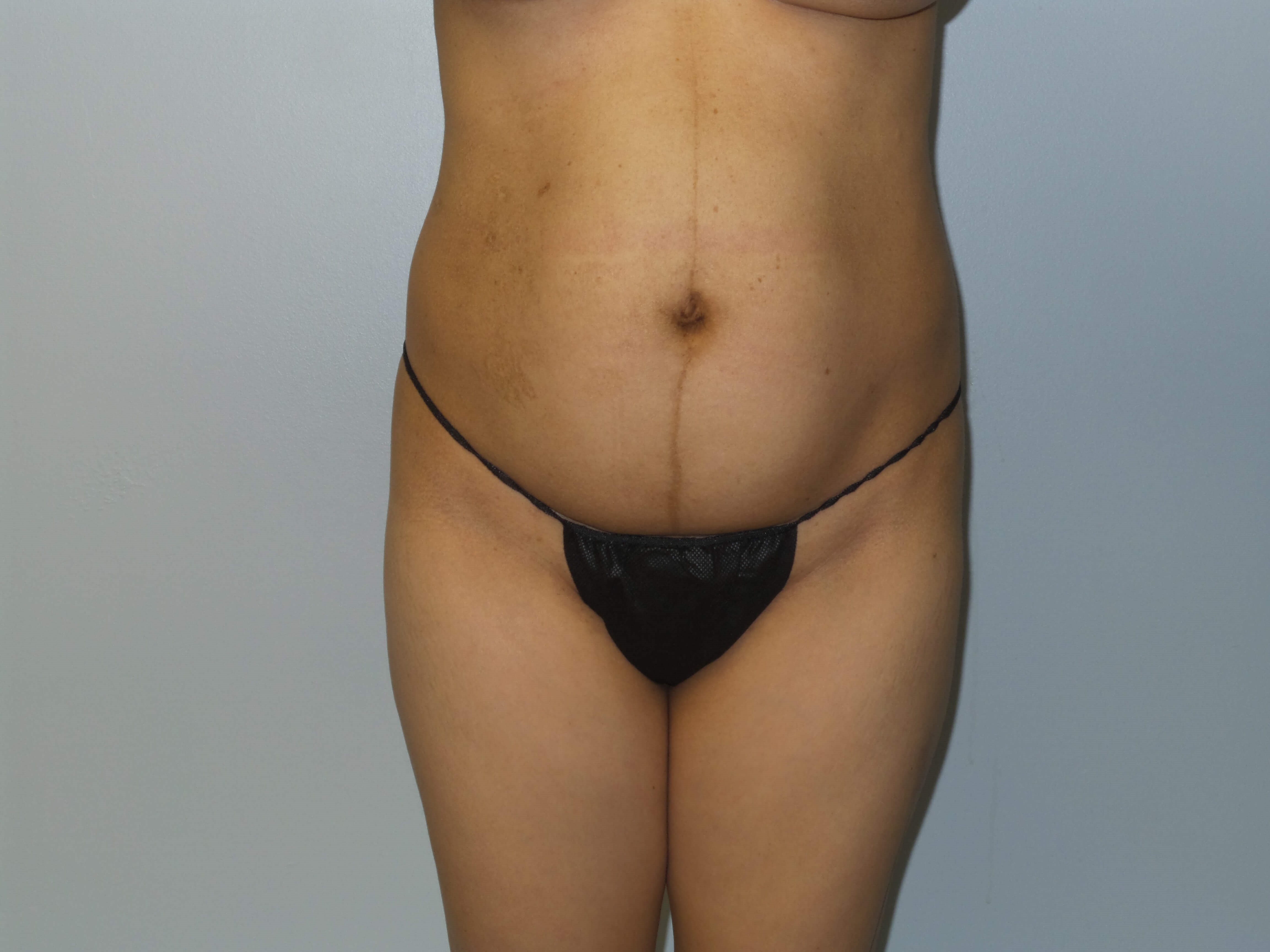 Westlake Woman Has BBL Before