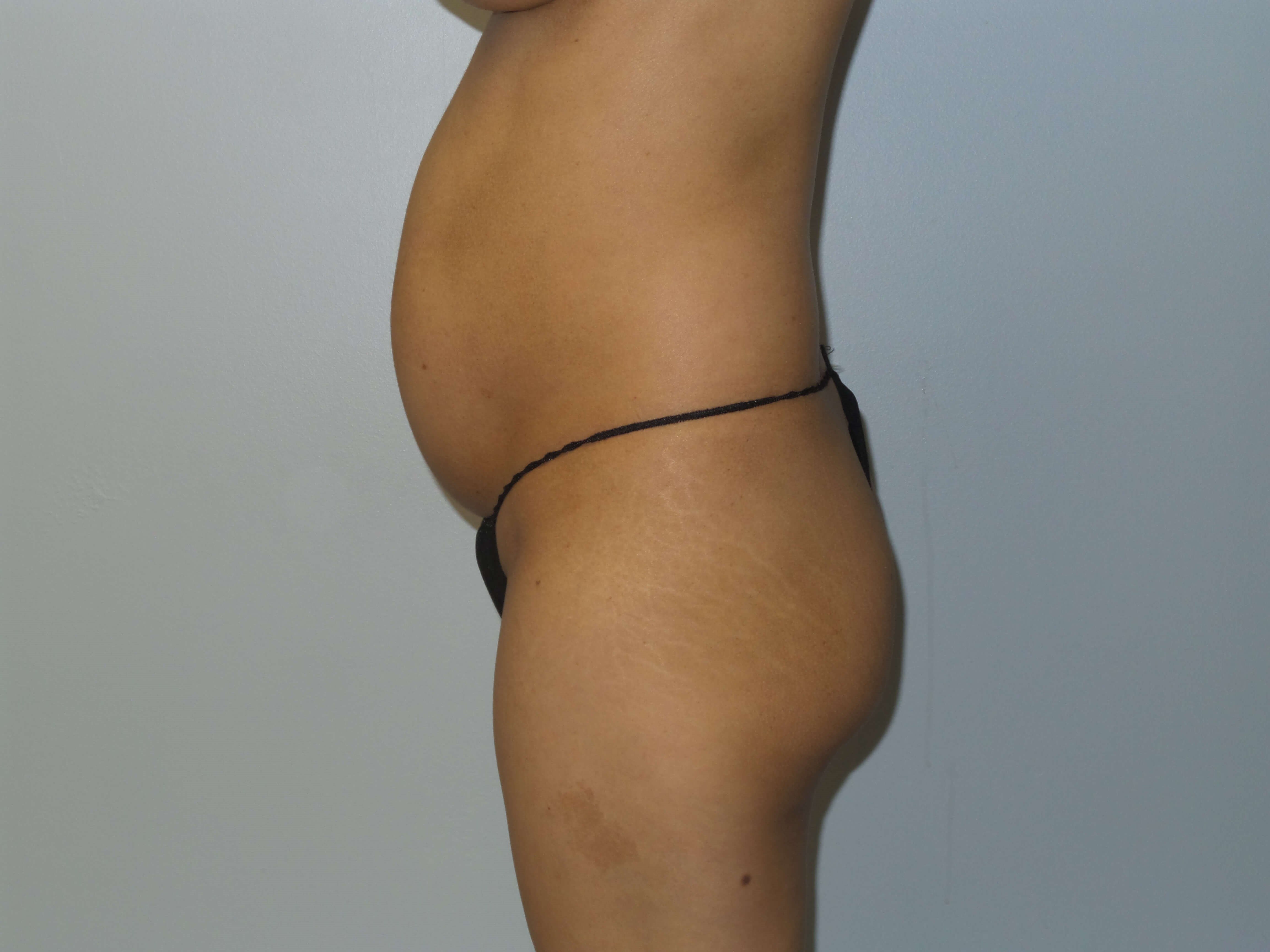 Westlake Woman Has BBL Before