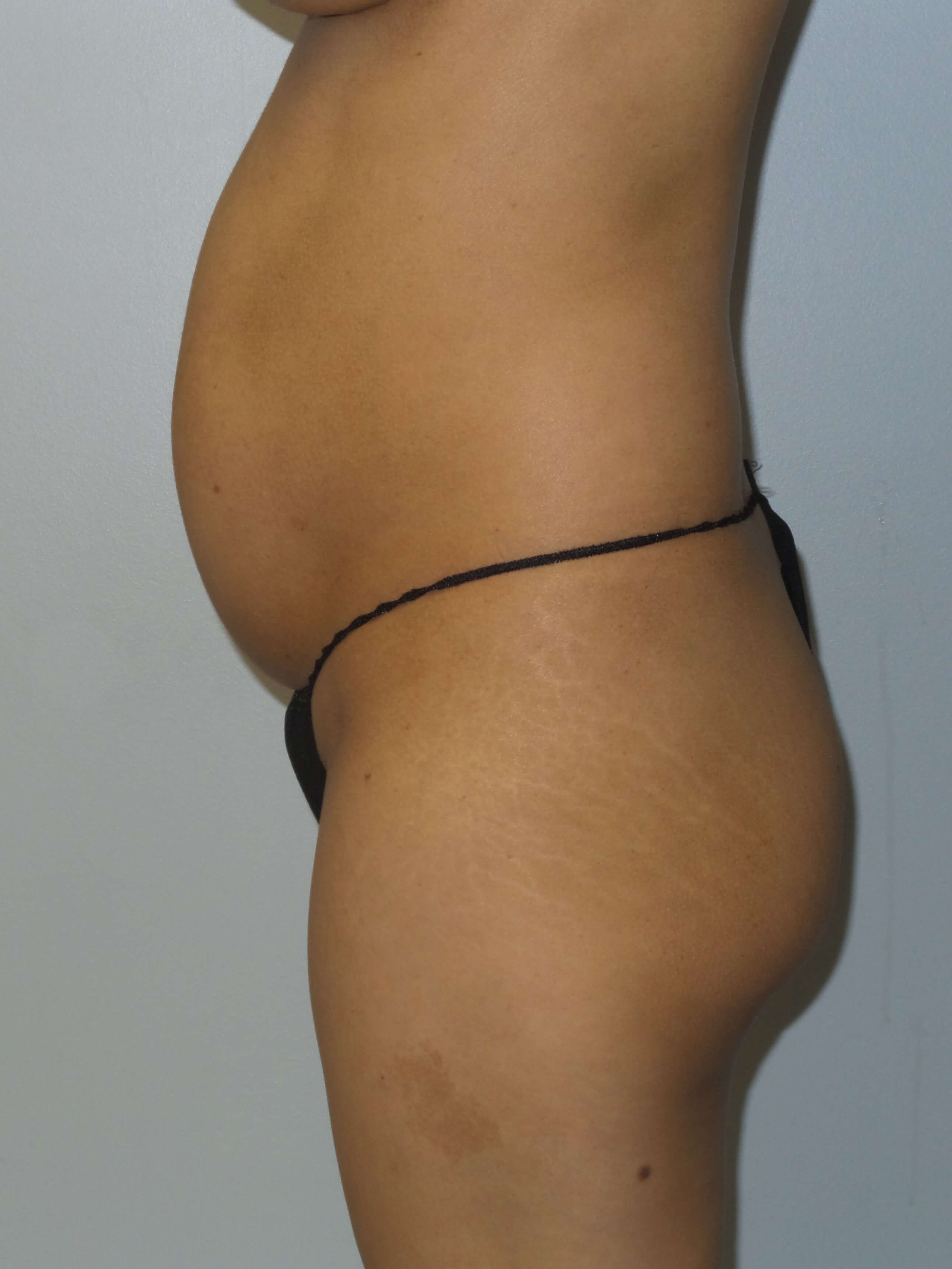 Westlake Woman Has BBL Before