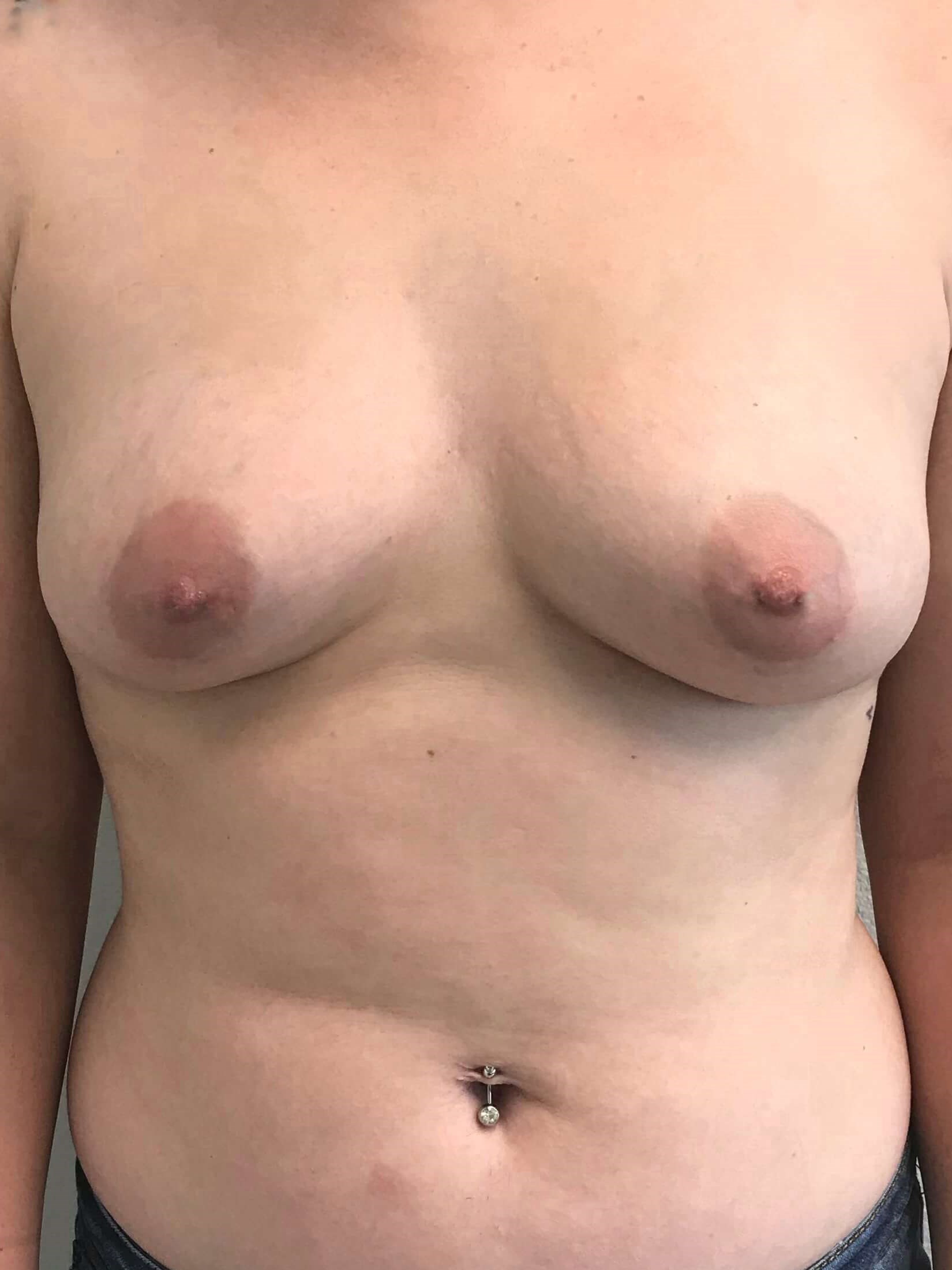 Westlake Woman Has Breast Aug Before