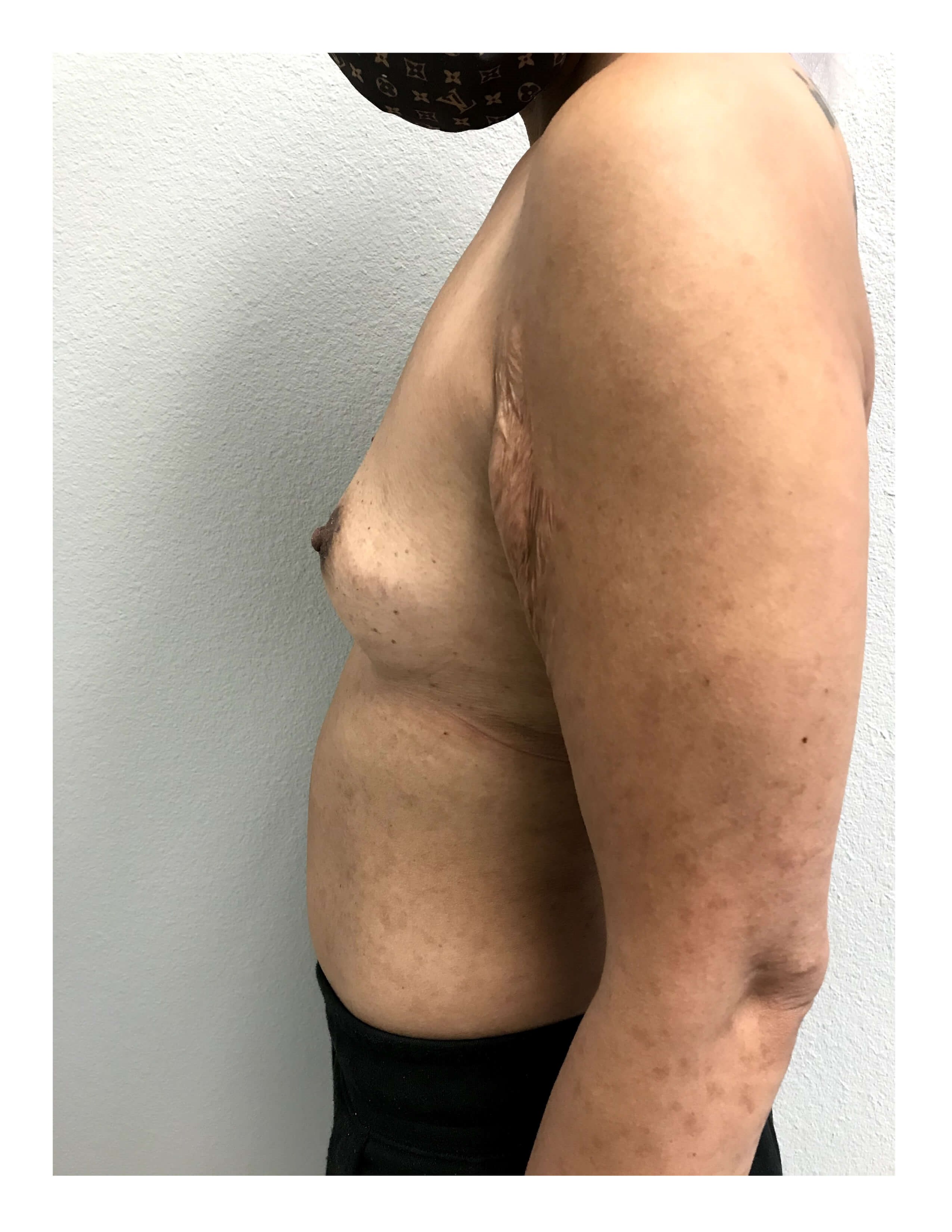 Westlake Woman Has Breast Aug Before
