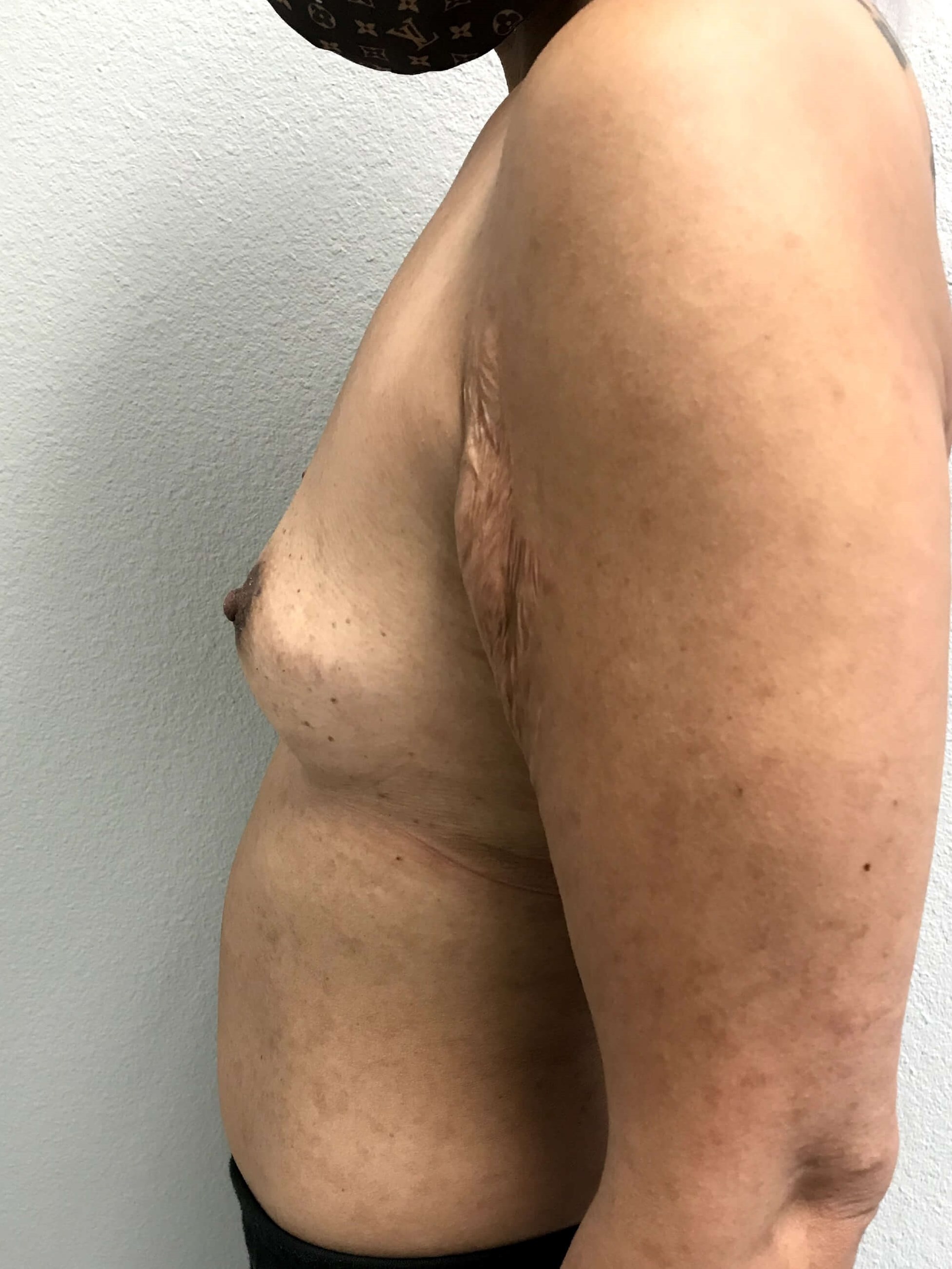 Westlake Woman Has Breast Aug Before