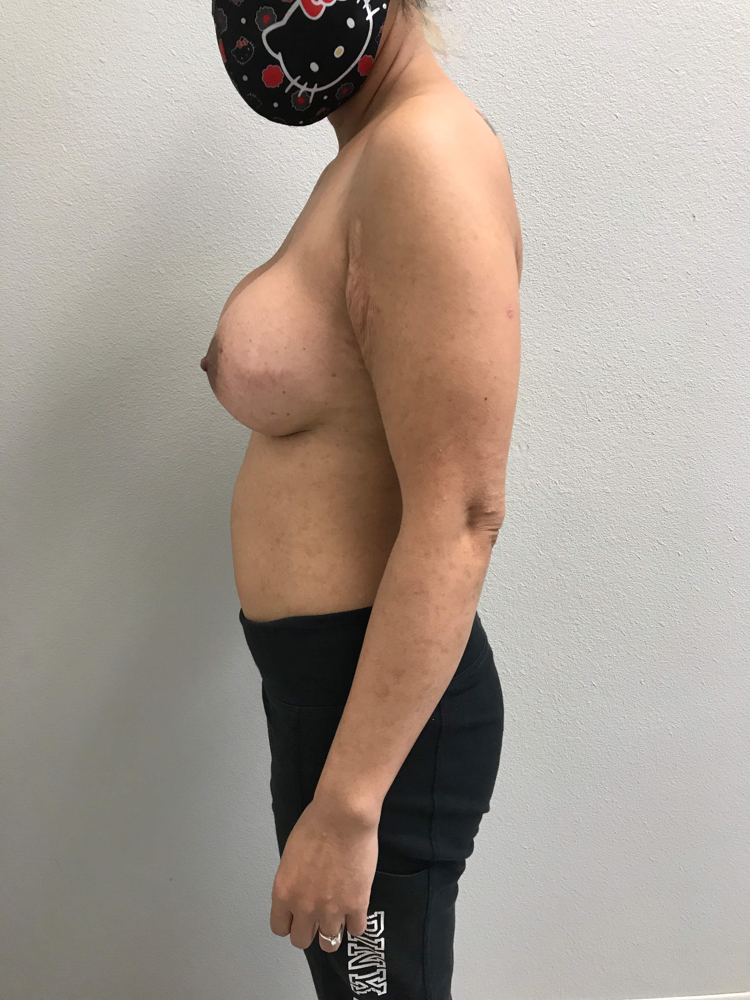Westlake Woman Has Breast Aug After