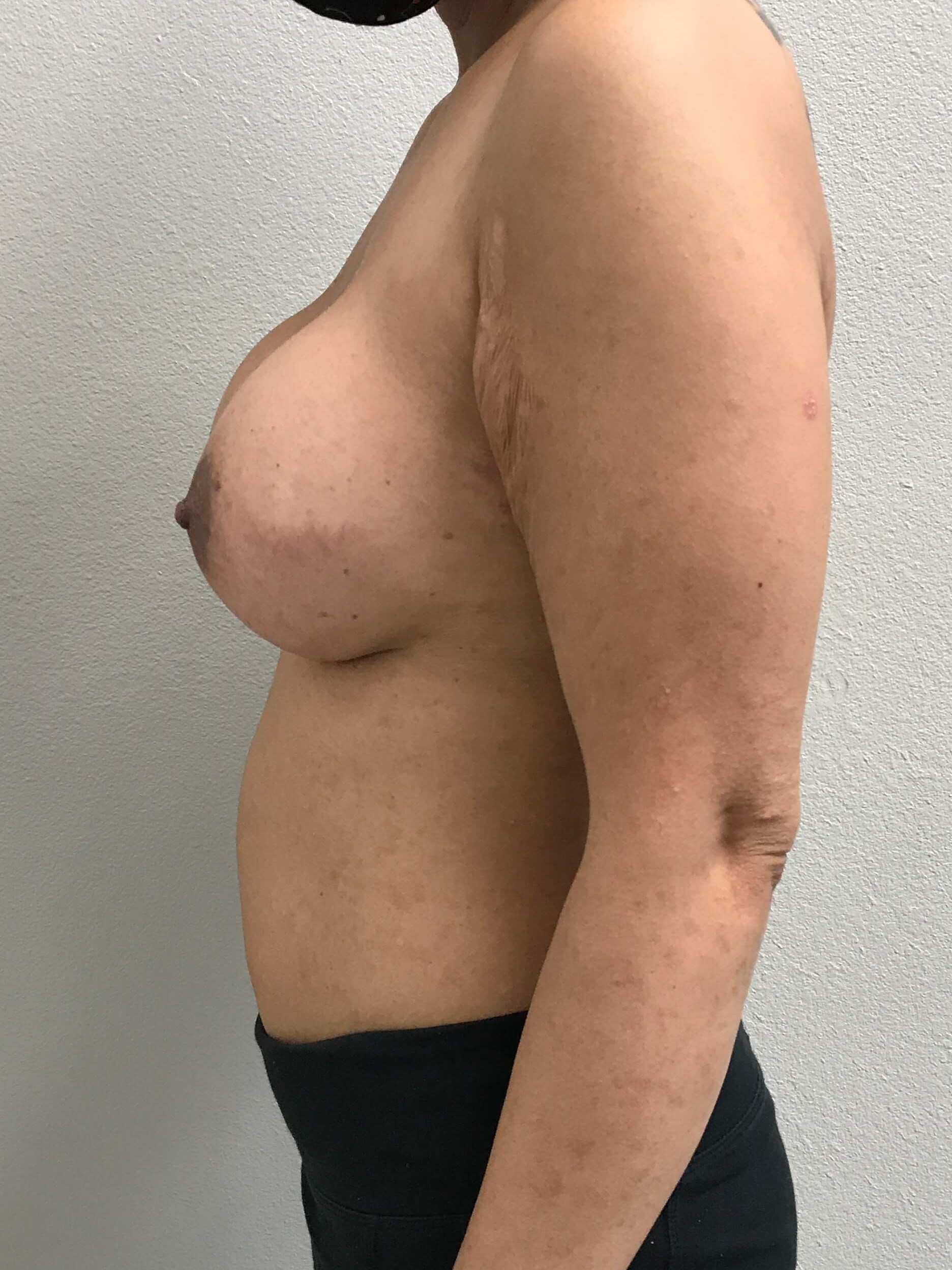 Westlake Woman Has Breast Aug After