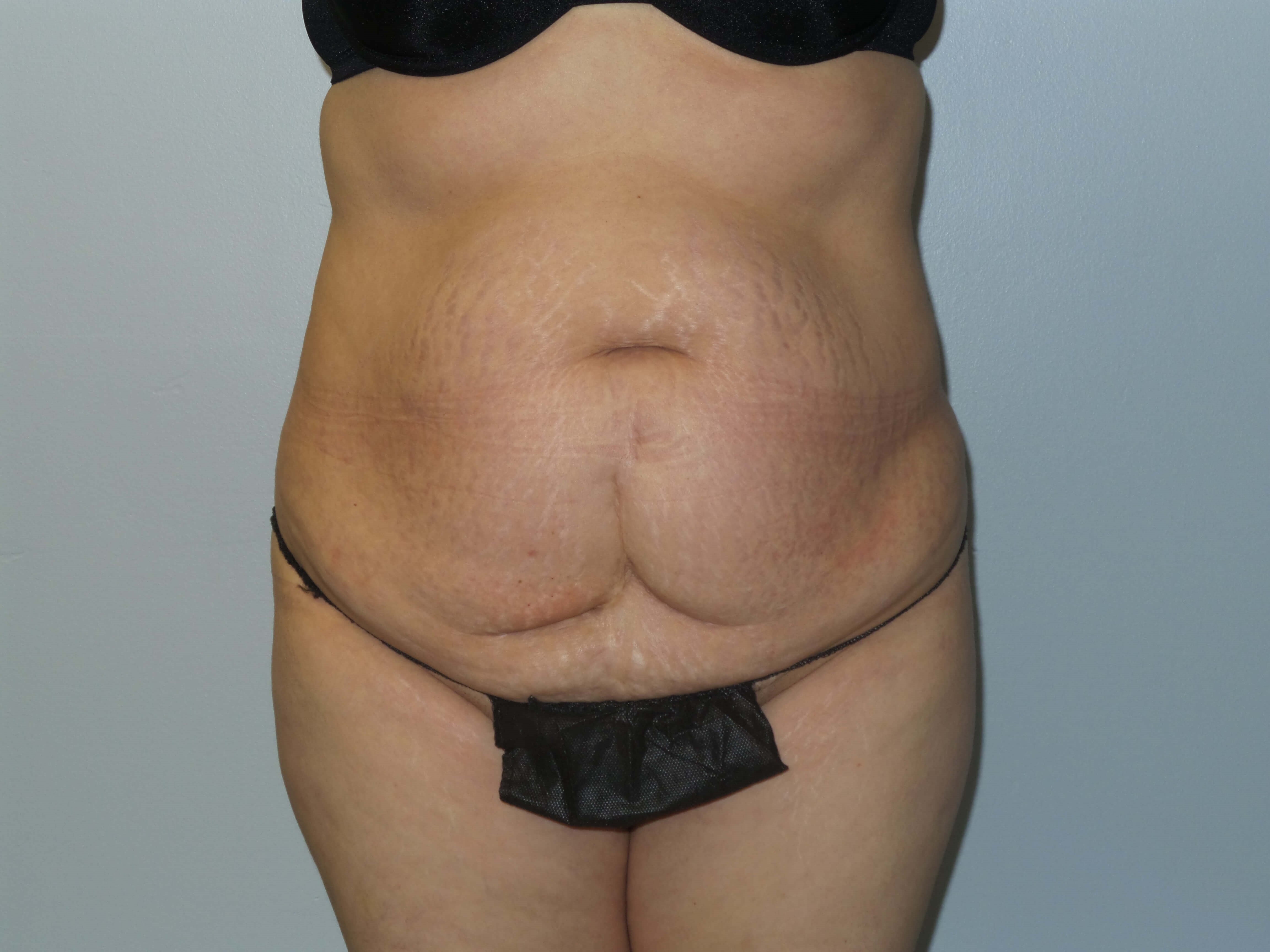 Woman Has Tummy Tuck Lipo Before