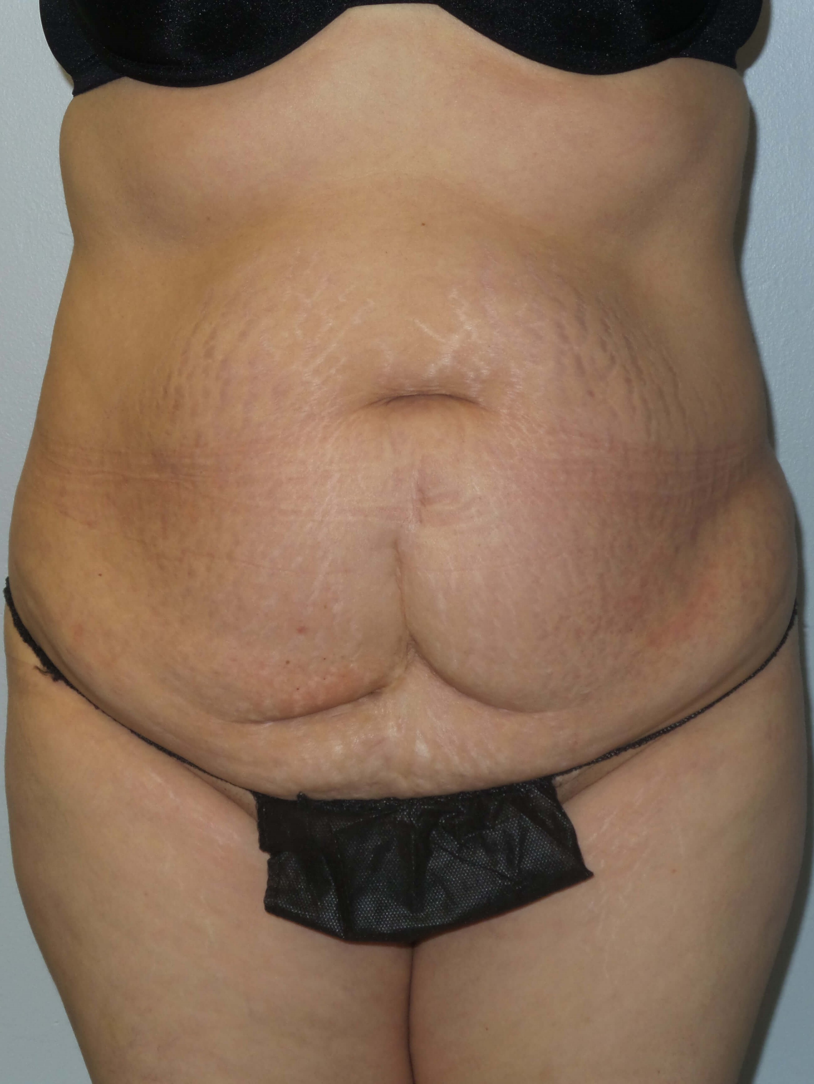 Woman Has Tummy Tuck Lipo Before
