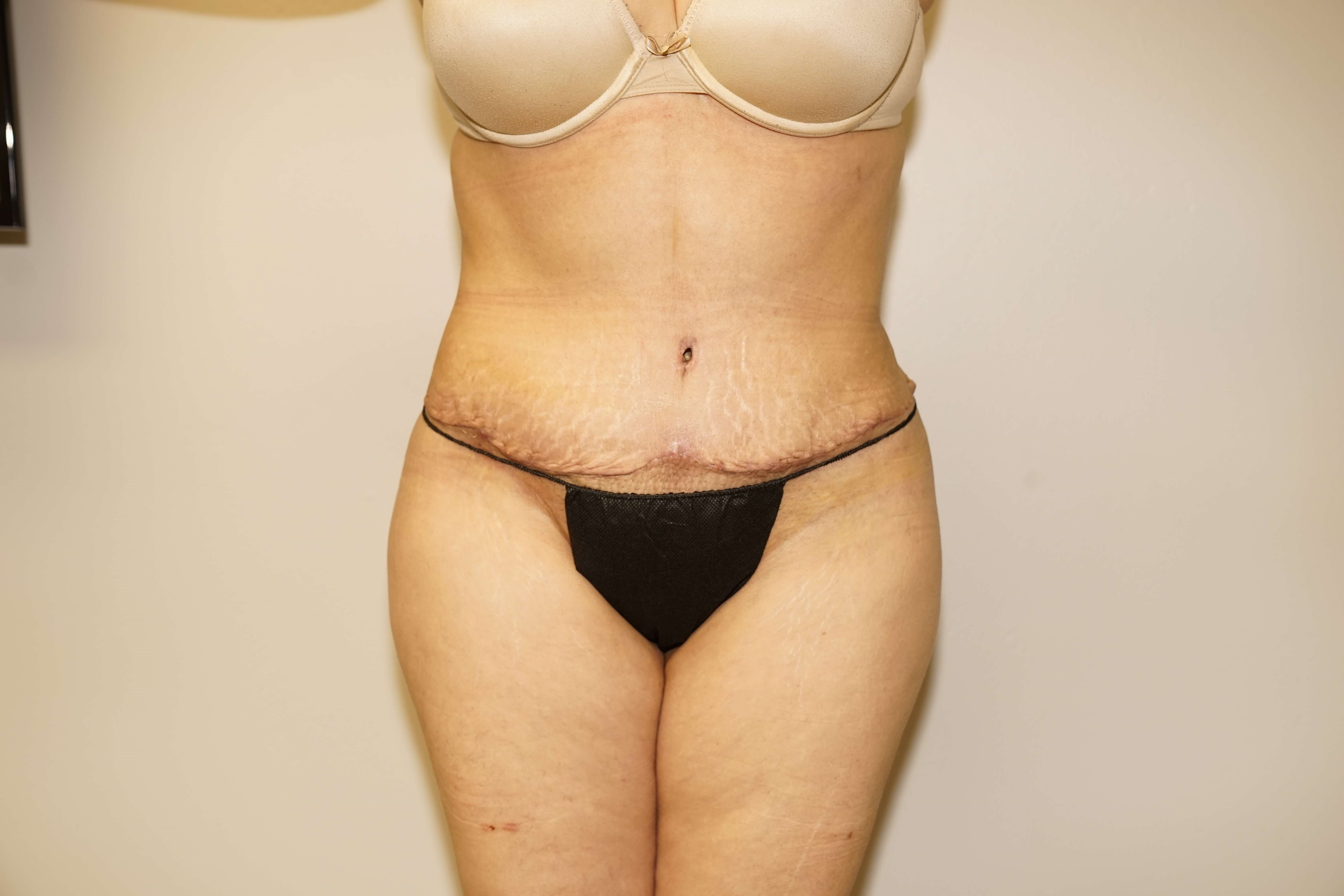 Woman Has Tummy Tuck Lipo After