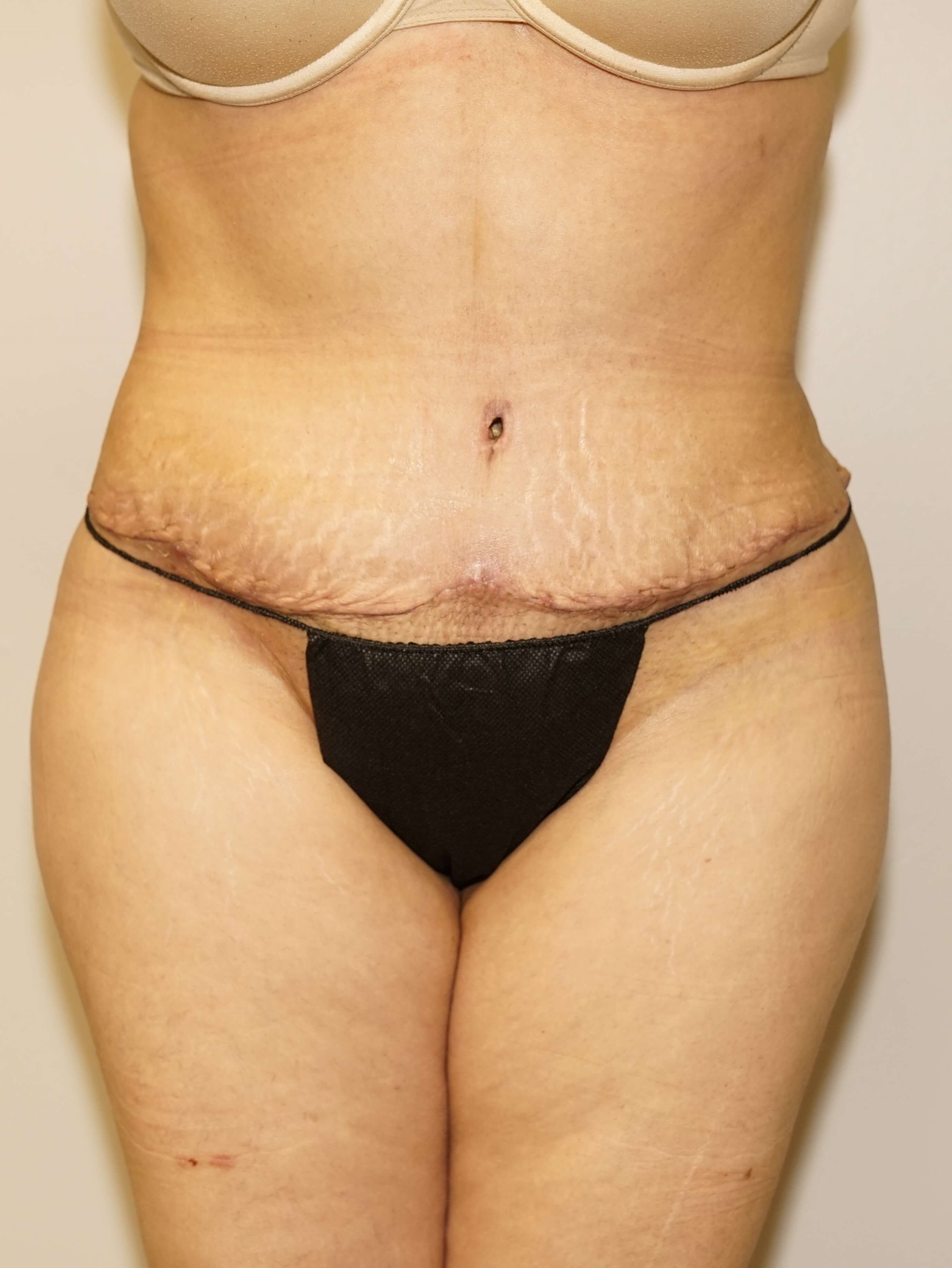 Woman Has Tummy Tuck Lipo After