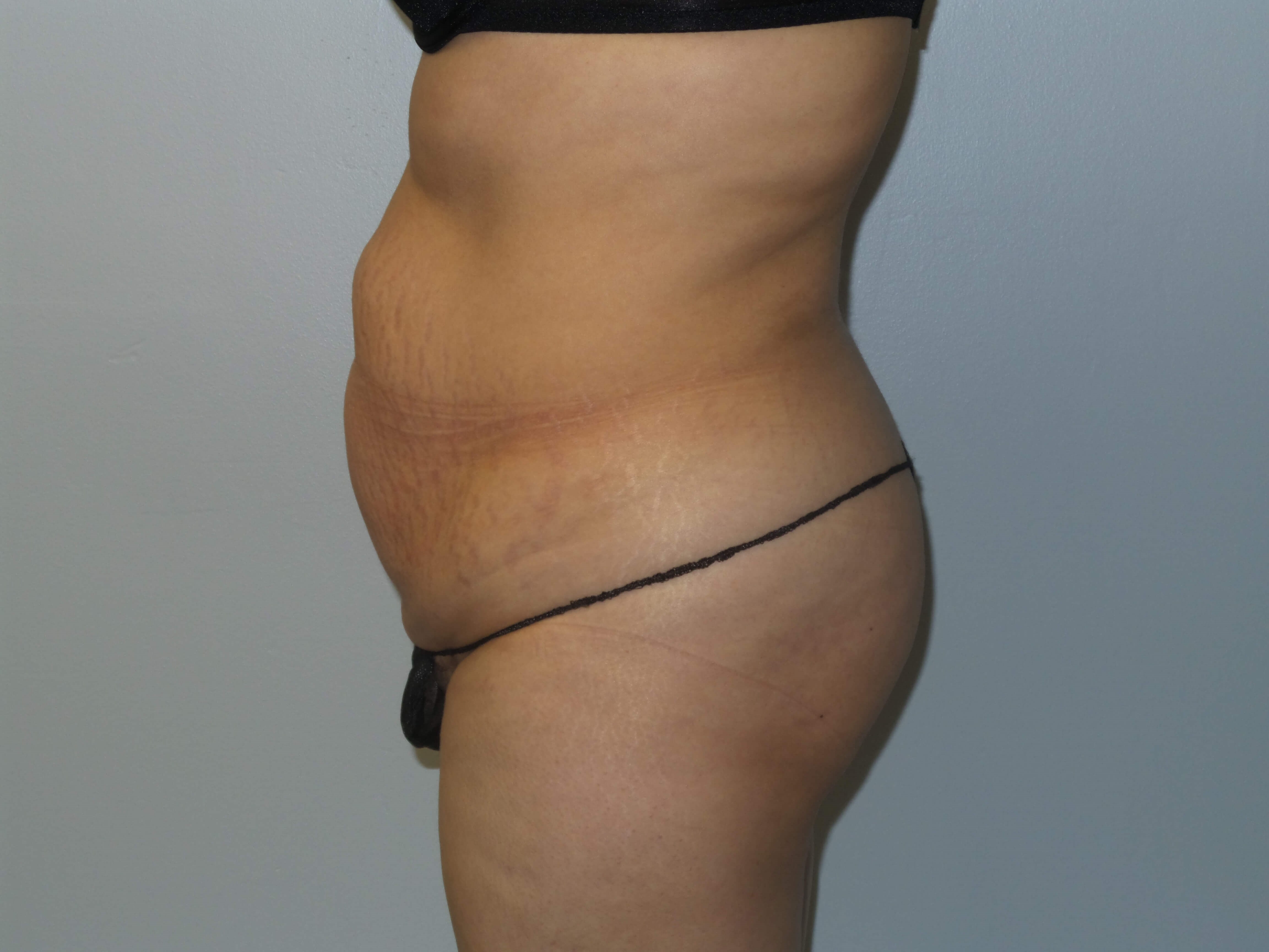 Woman Has Tummy Tuck Lipo Before