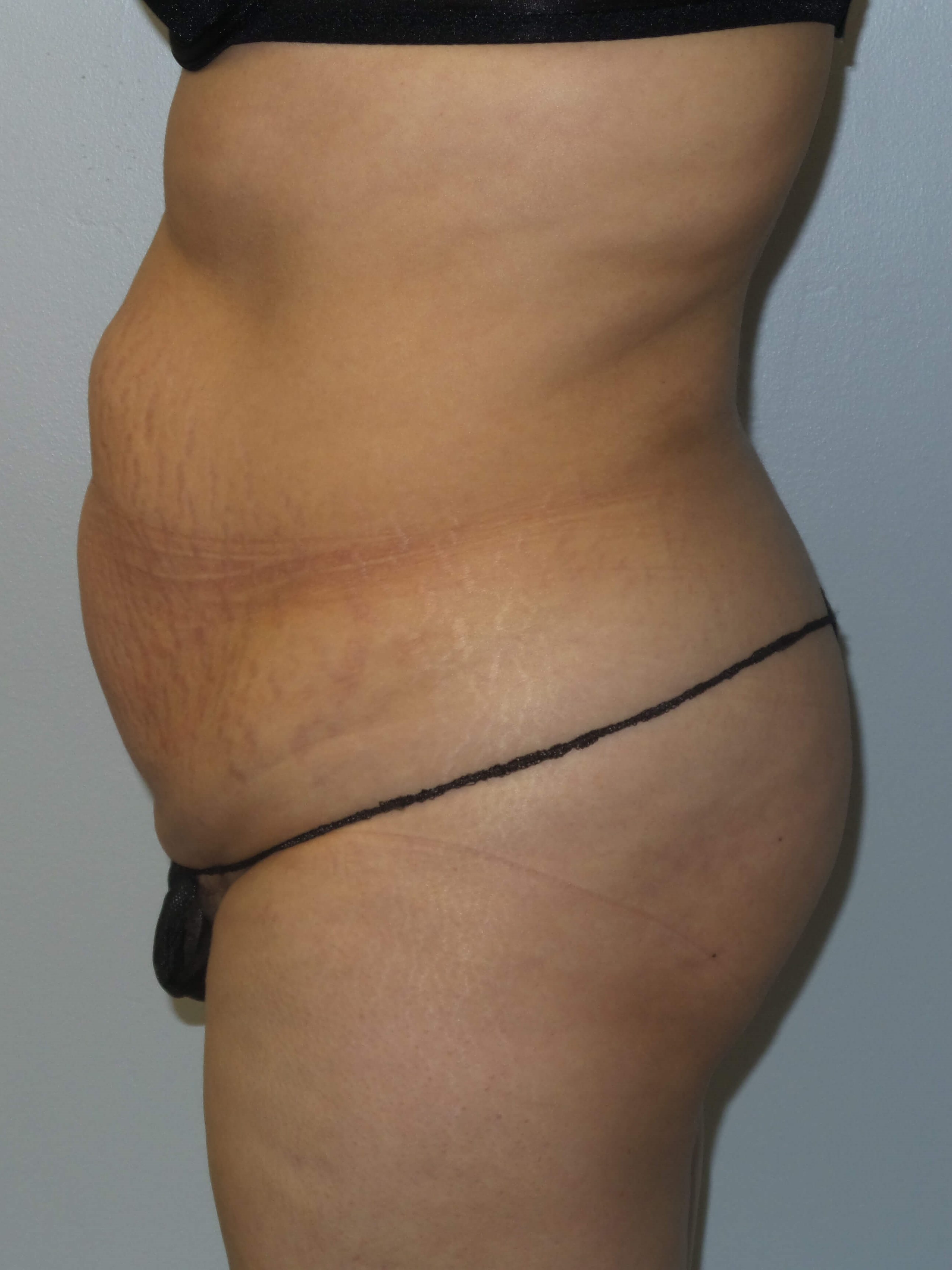 Woman Has Tummy Tuck Lipo Before