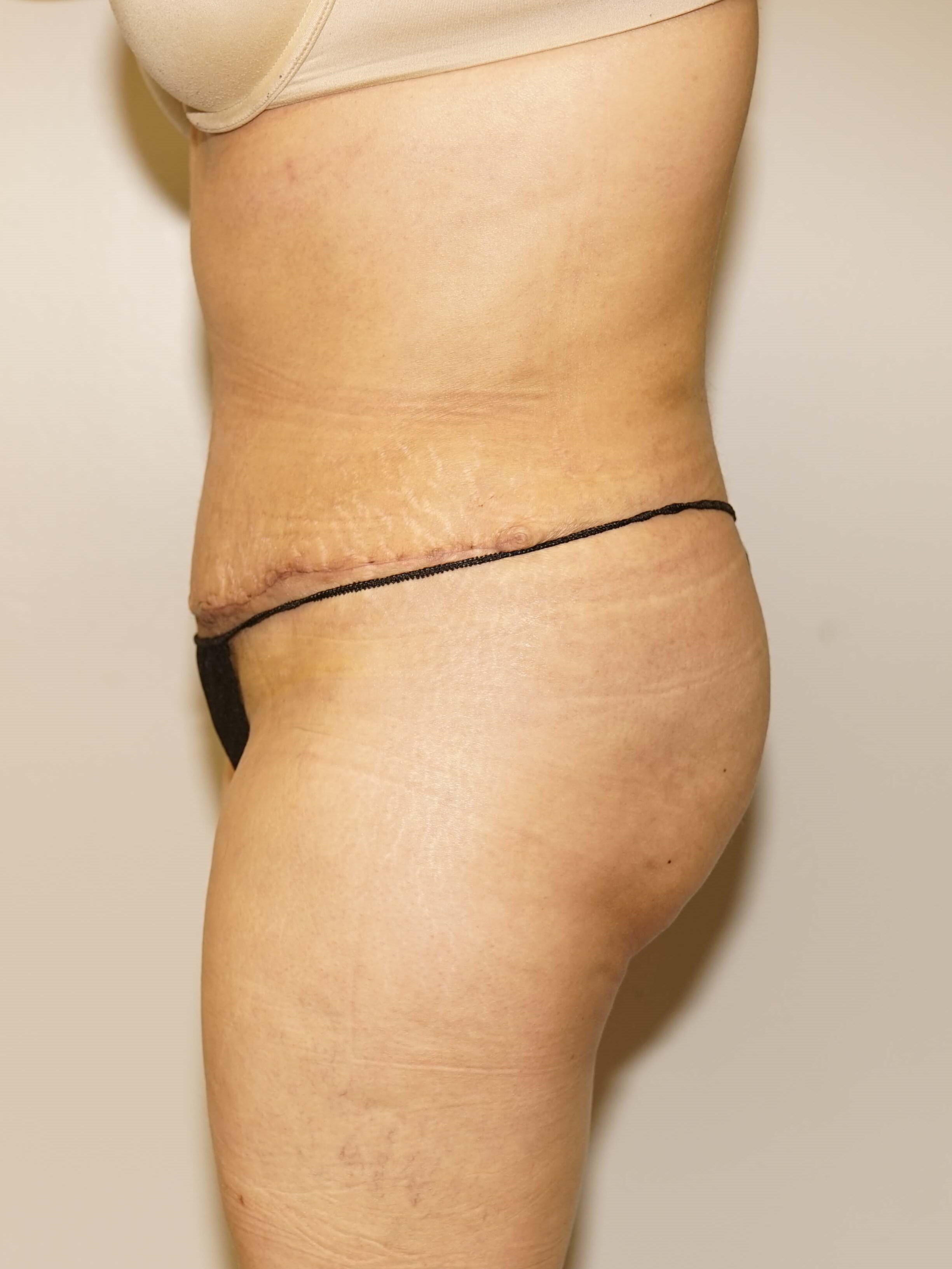 Woman Has Tummy Tuck Lipo After