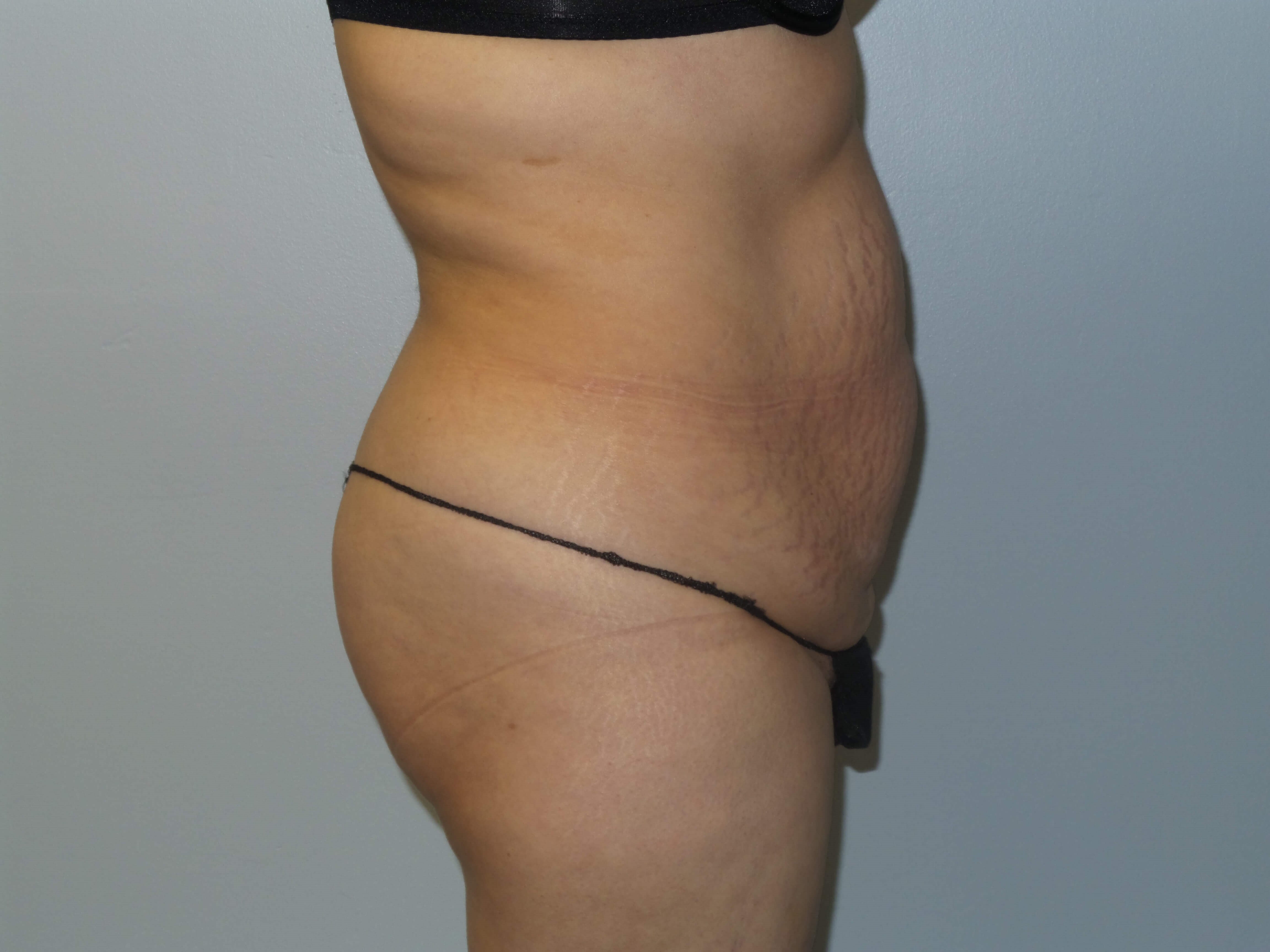 Woman Has Tummy Tuck Lipo Before