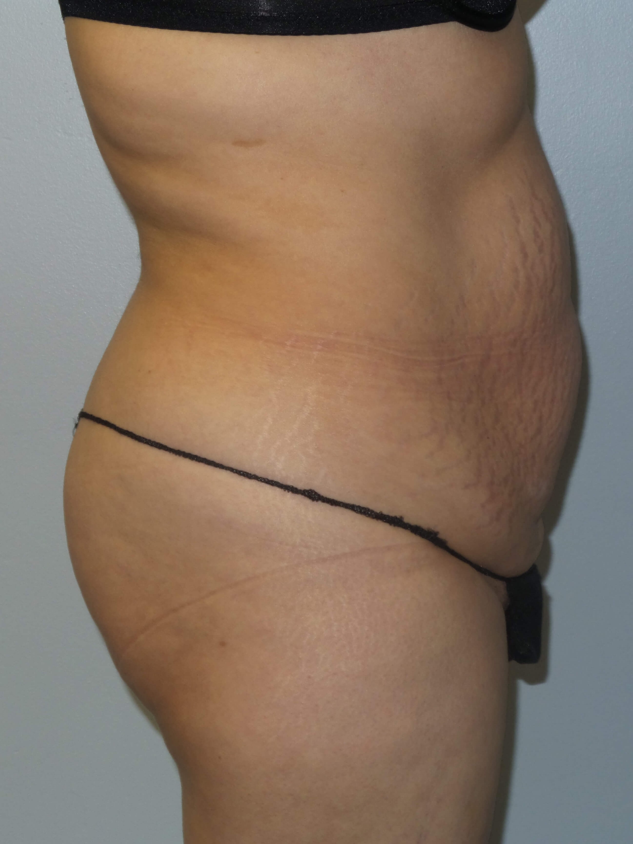Woman Has Tummy Tuck Lipo Before