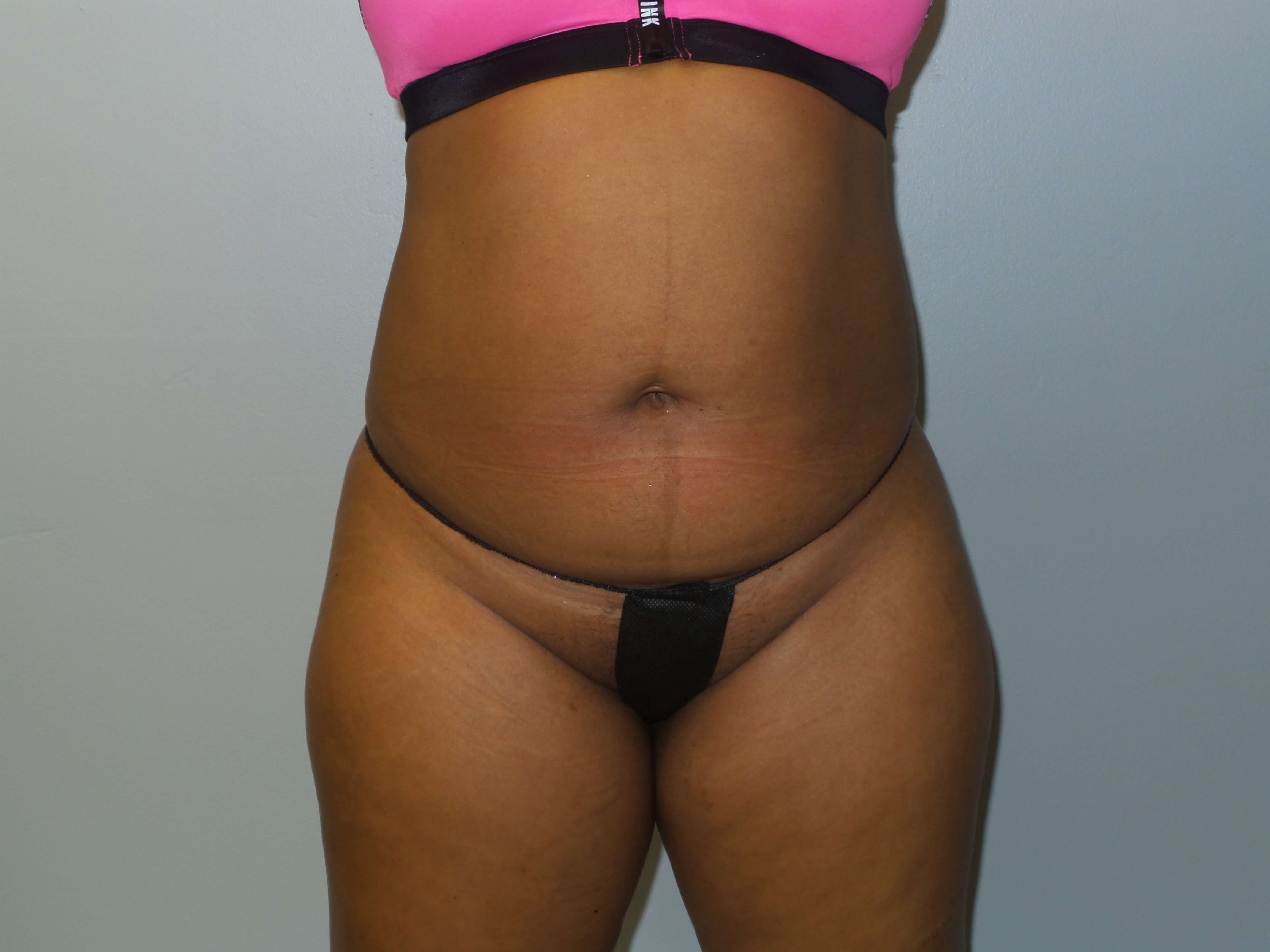 Westlake Woman Has Liposuction Before
