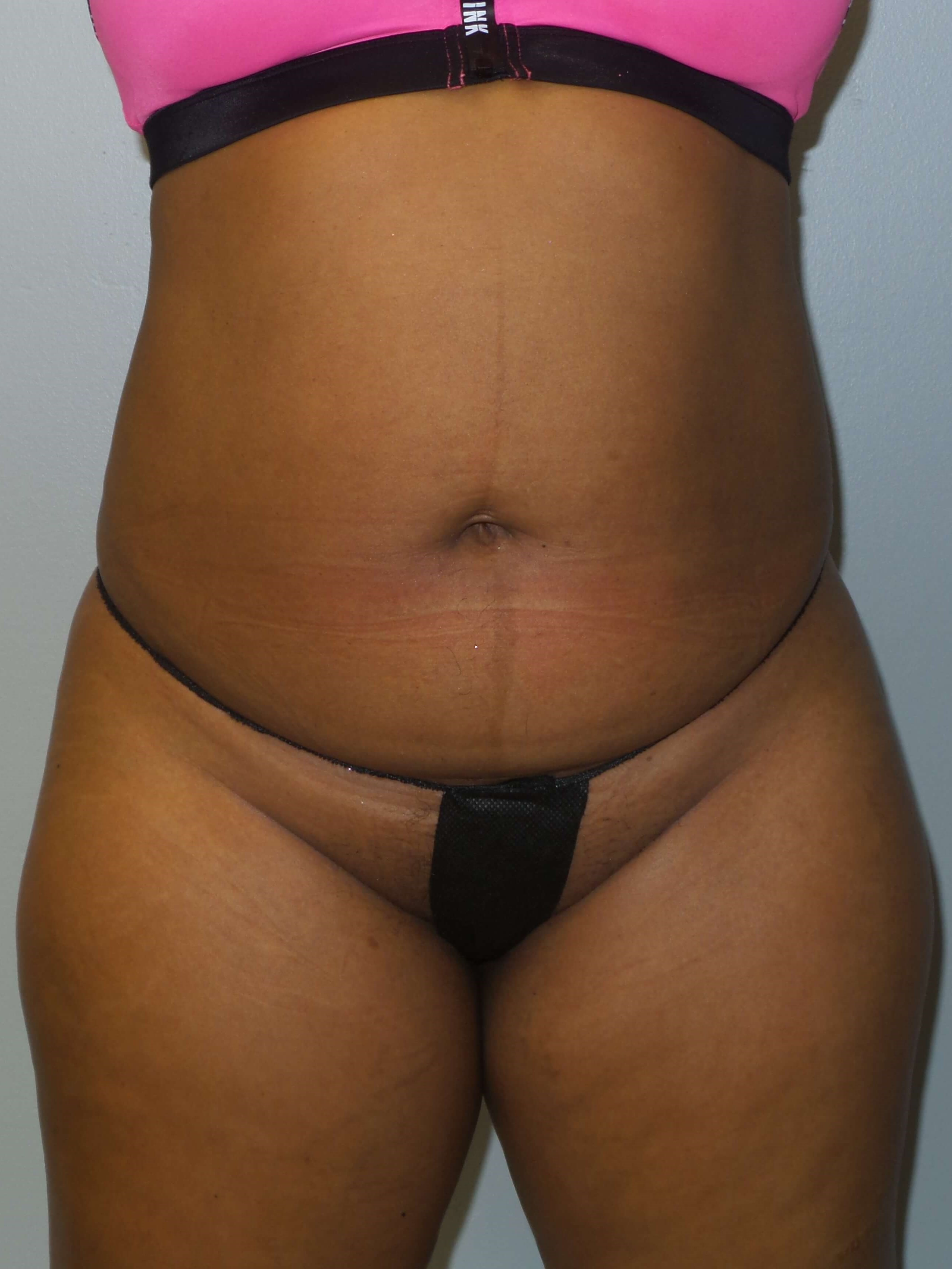 Westlake Woman Has Liposuction Before