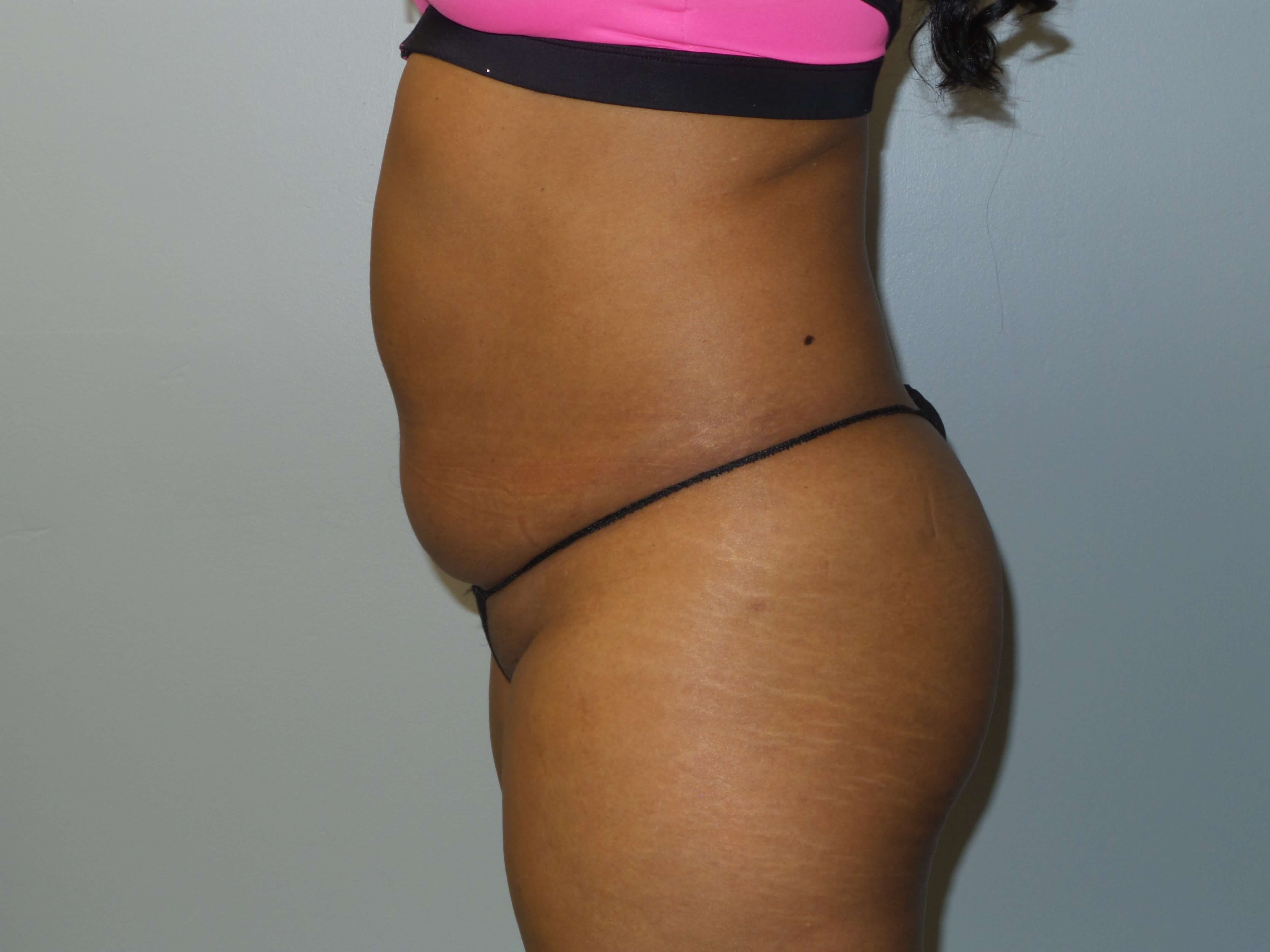 Westlake Woman Has Liposuction Before