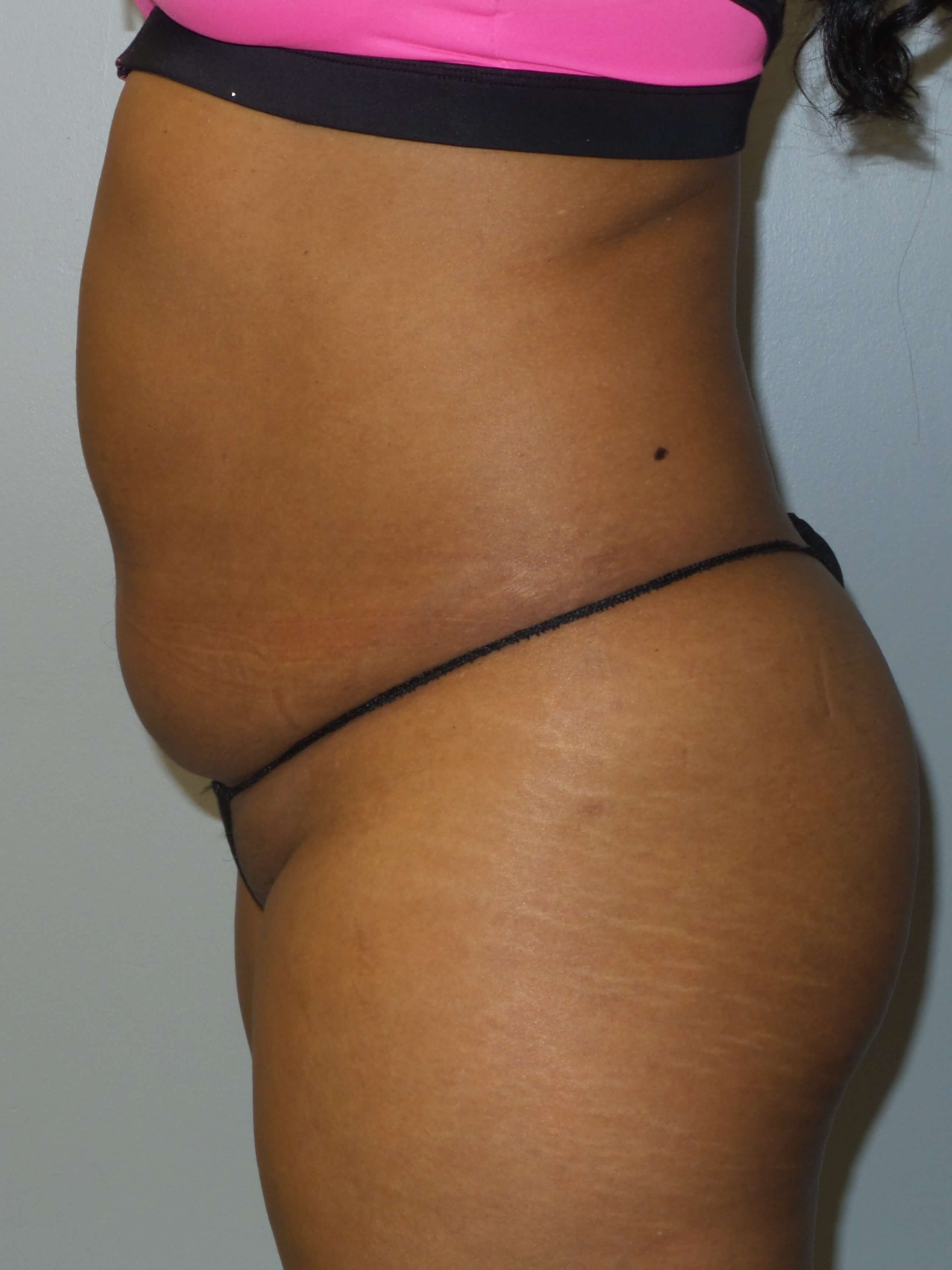 Westlake Woman Has Liposuction Before