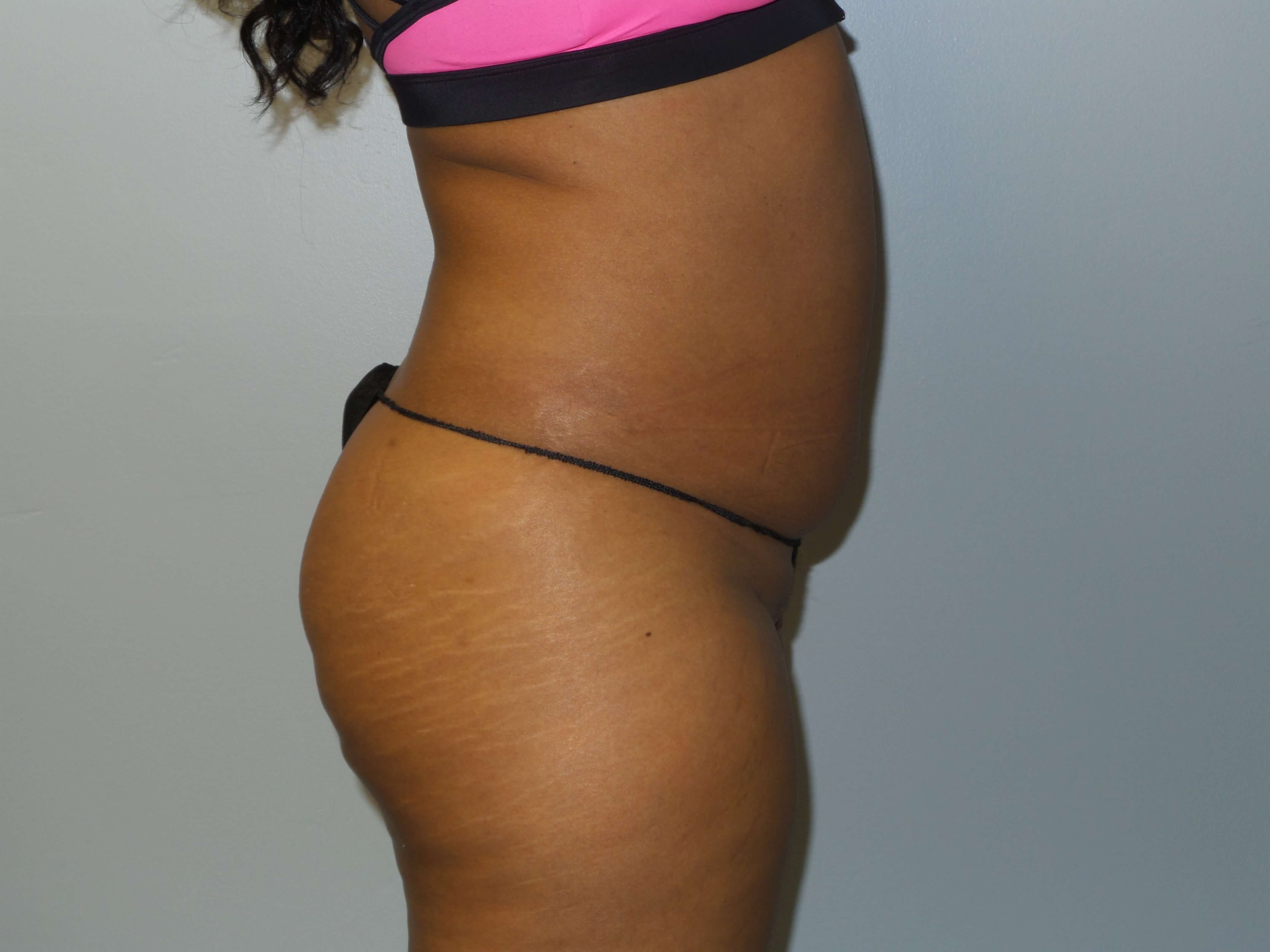 Westlake Woman Has Liposuction Before
