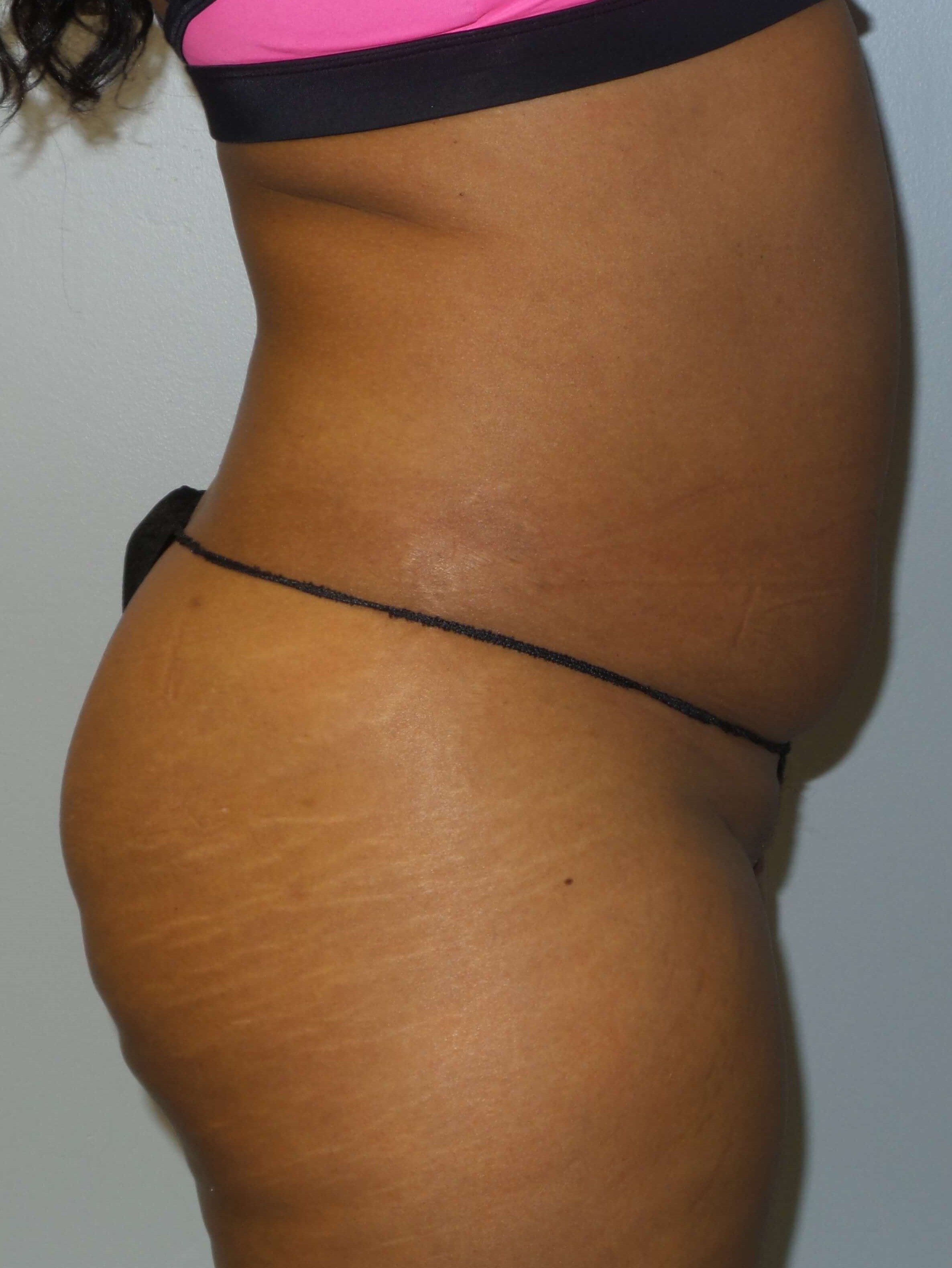 Westlake Woman Has Liposuction Before