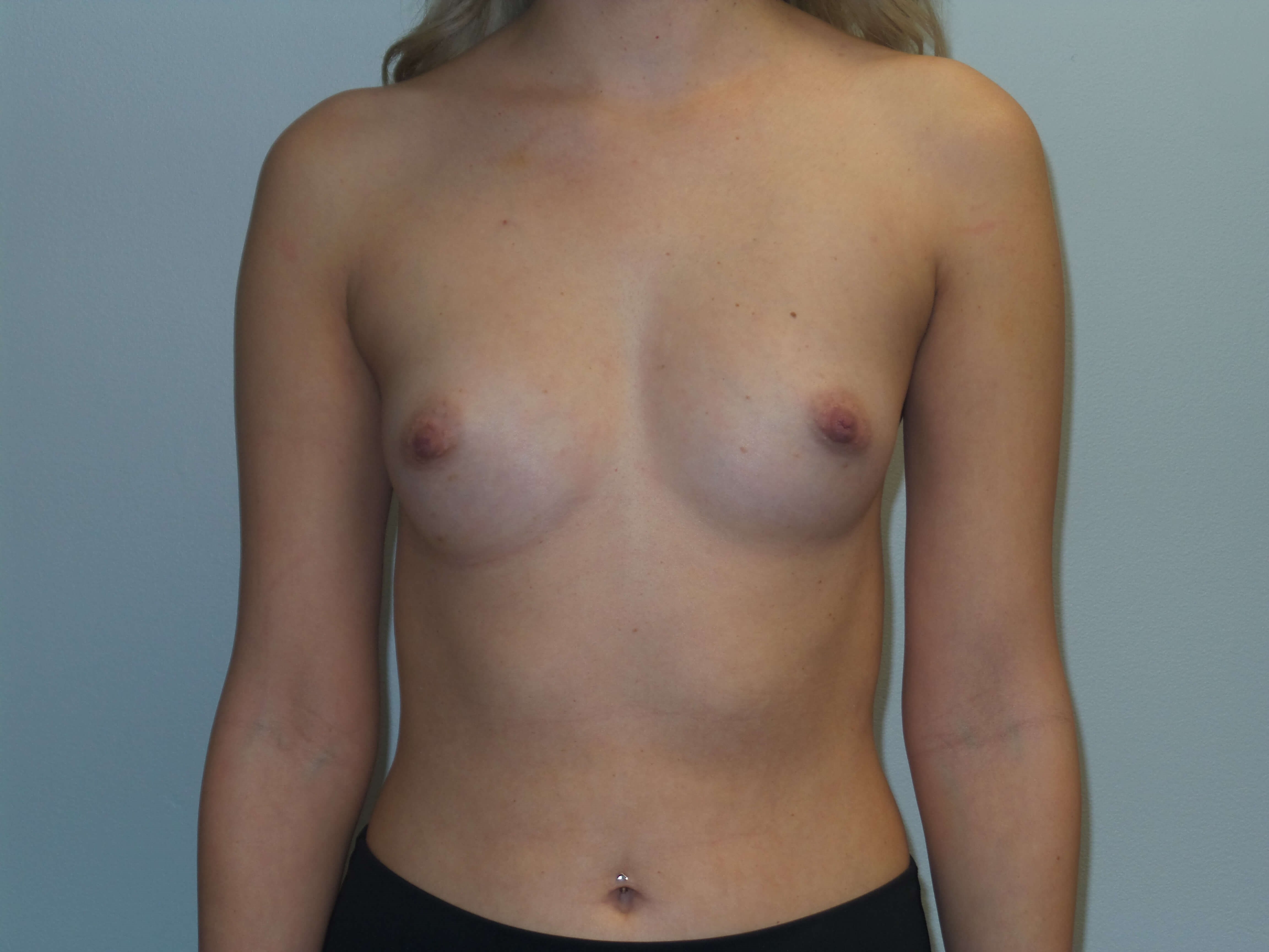 Westlake Woman Has Breast Aug Before