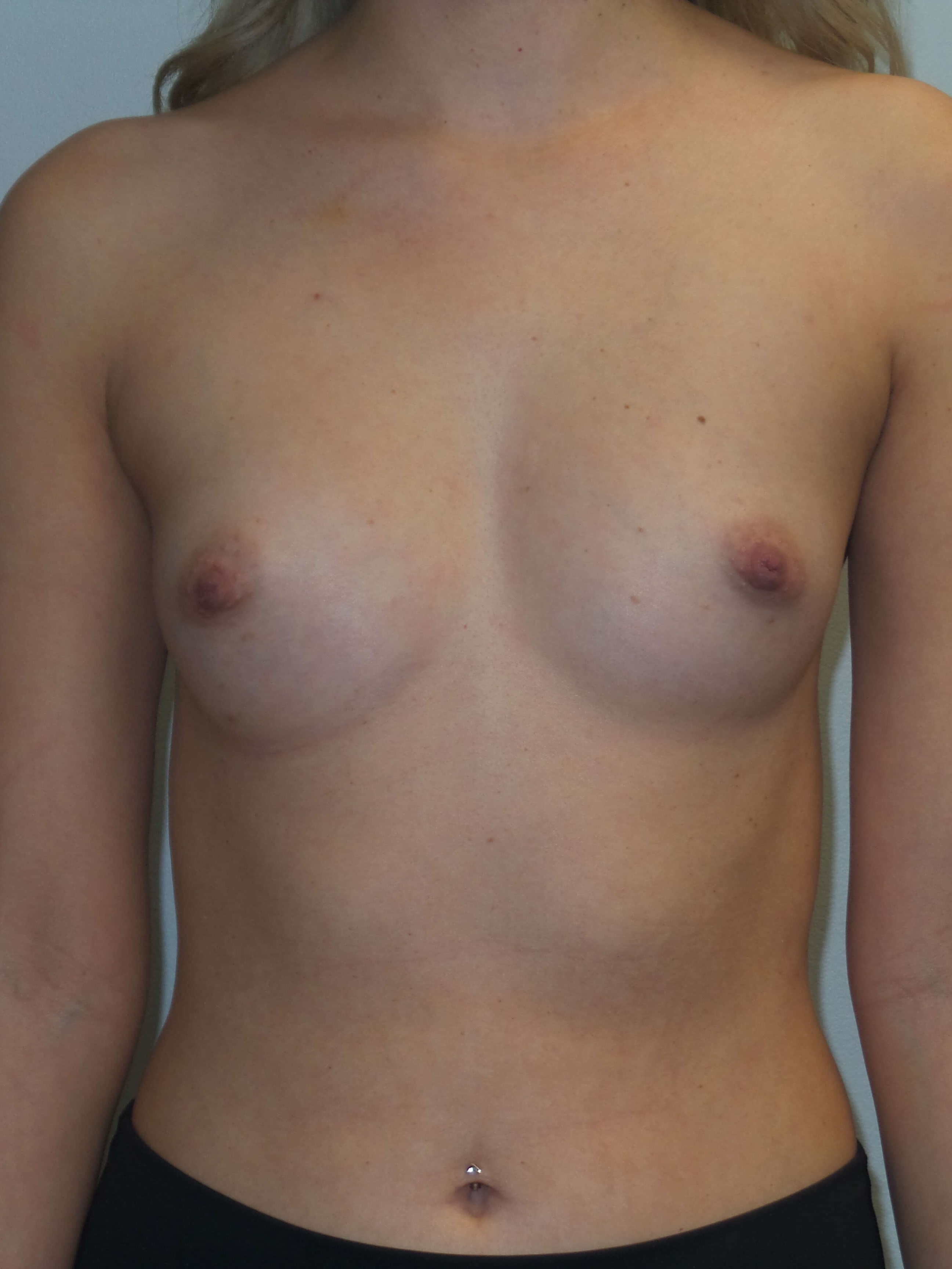 Westlake Woman Has Breast Aug Before