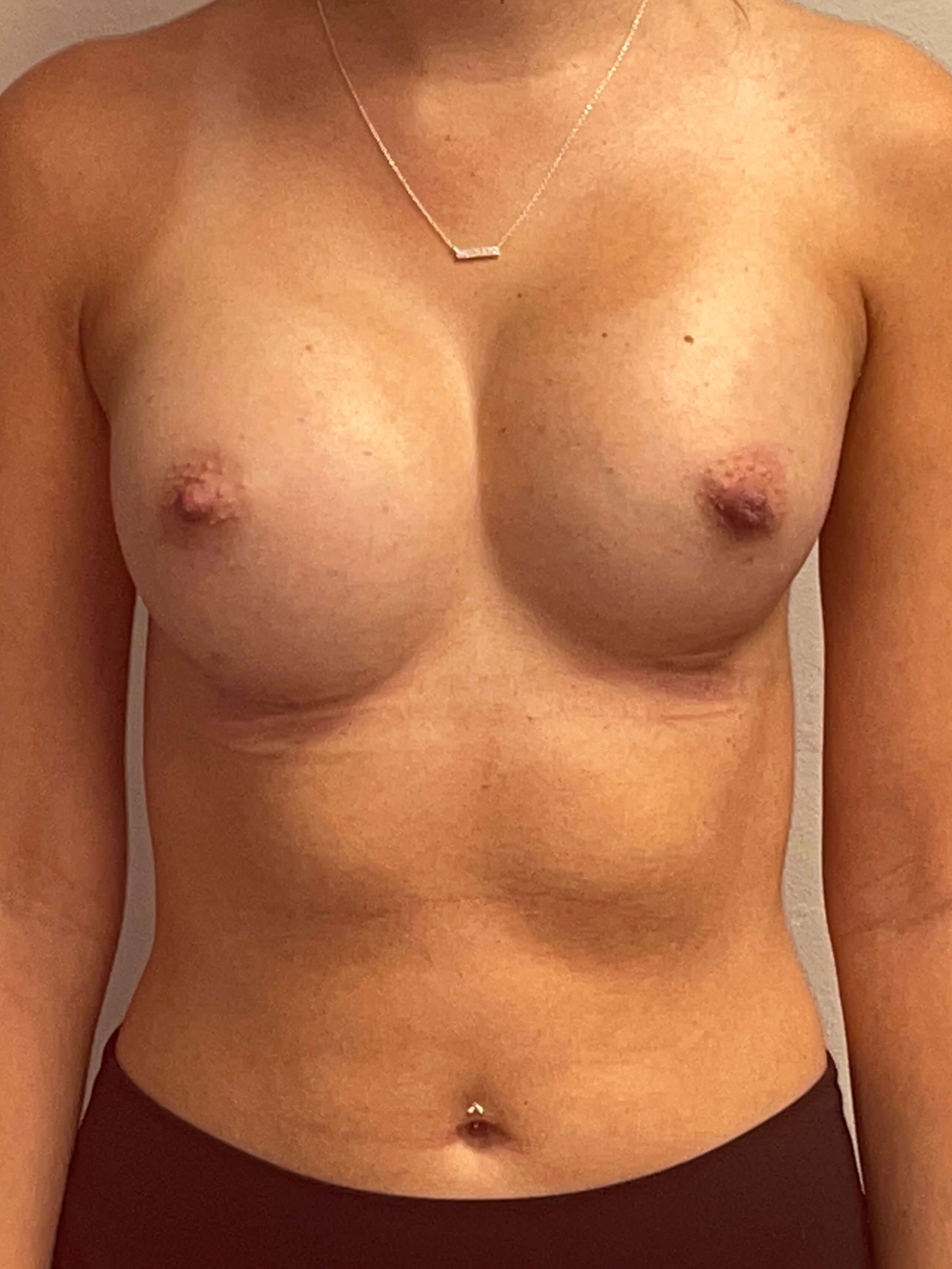 Westlake Woman Has Breast Aug After