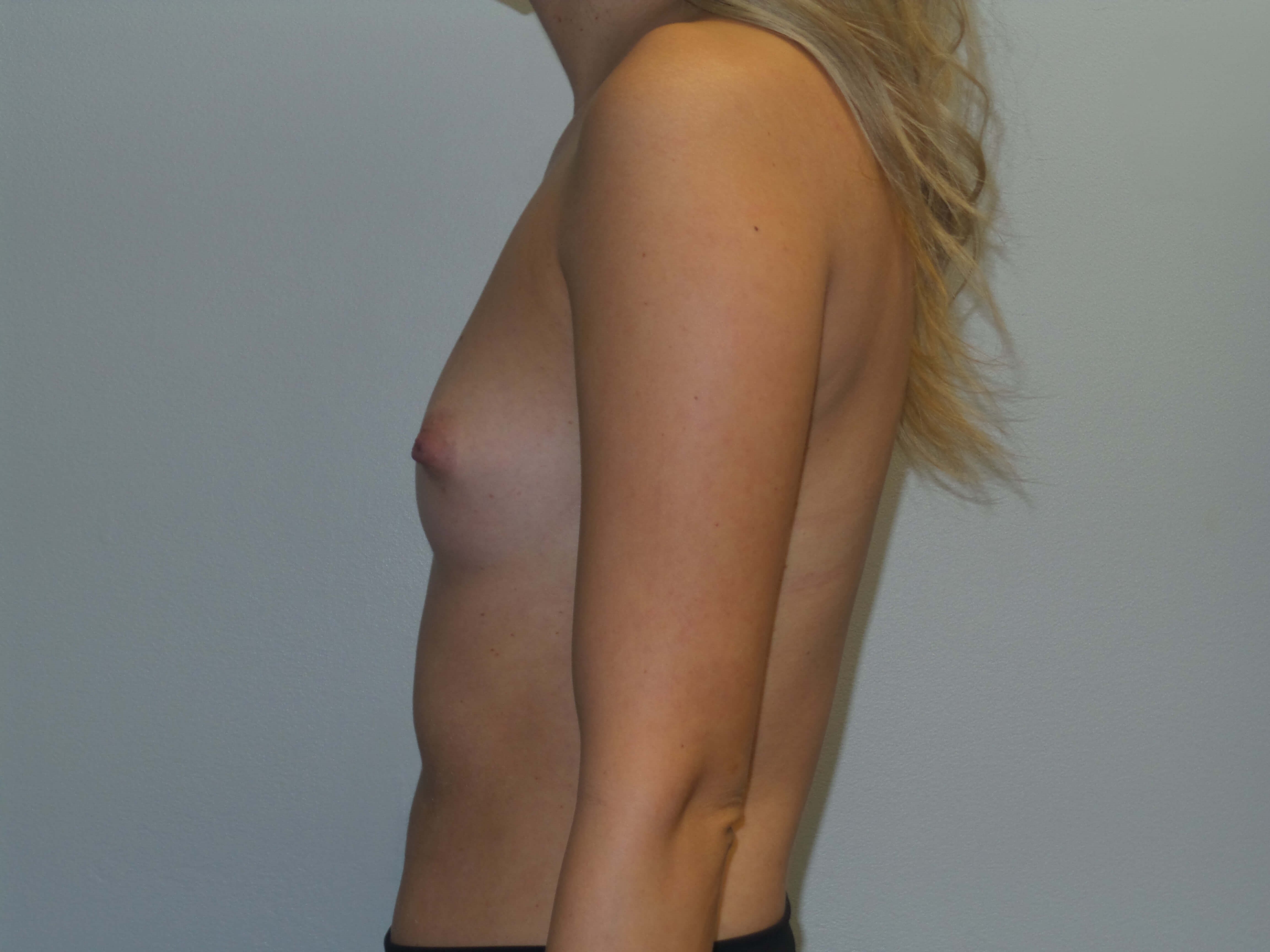 Westlake Woman Has Breast Aug Before