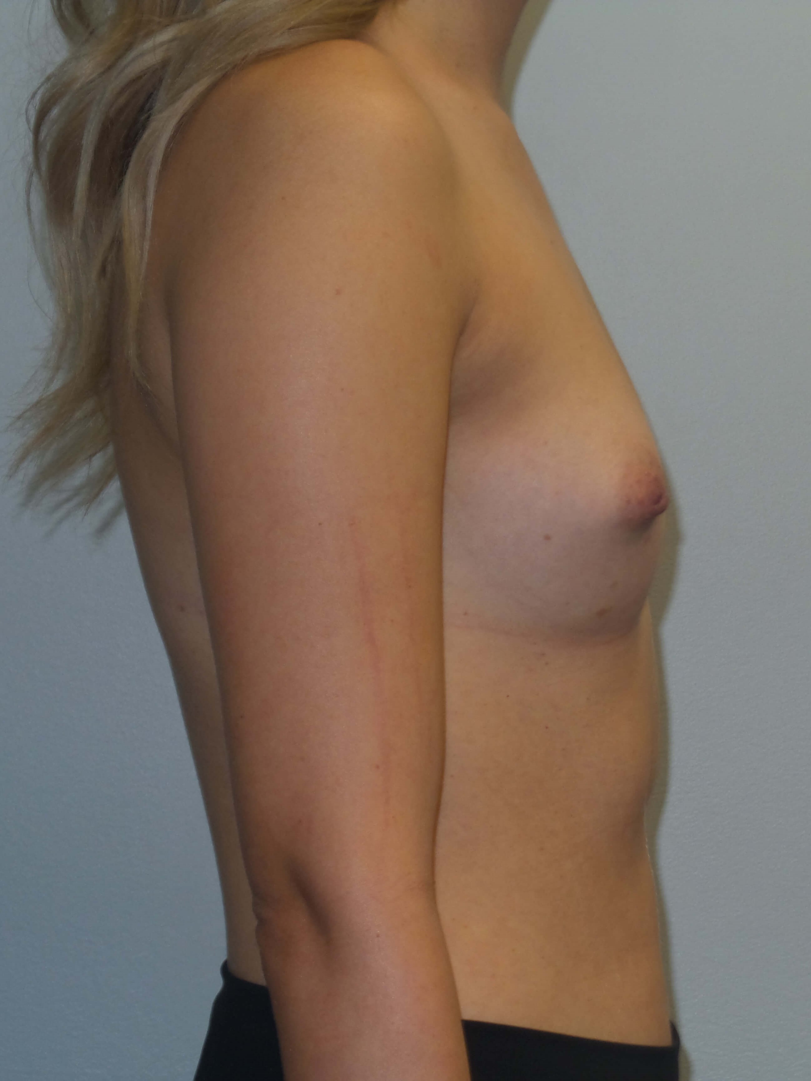 Westlake Woman Has Breast Aug Before