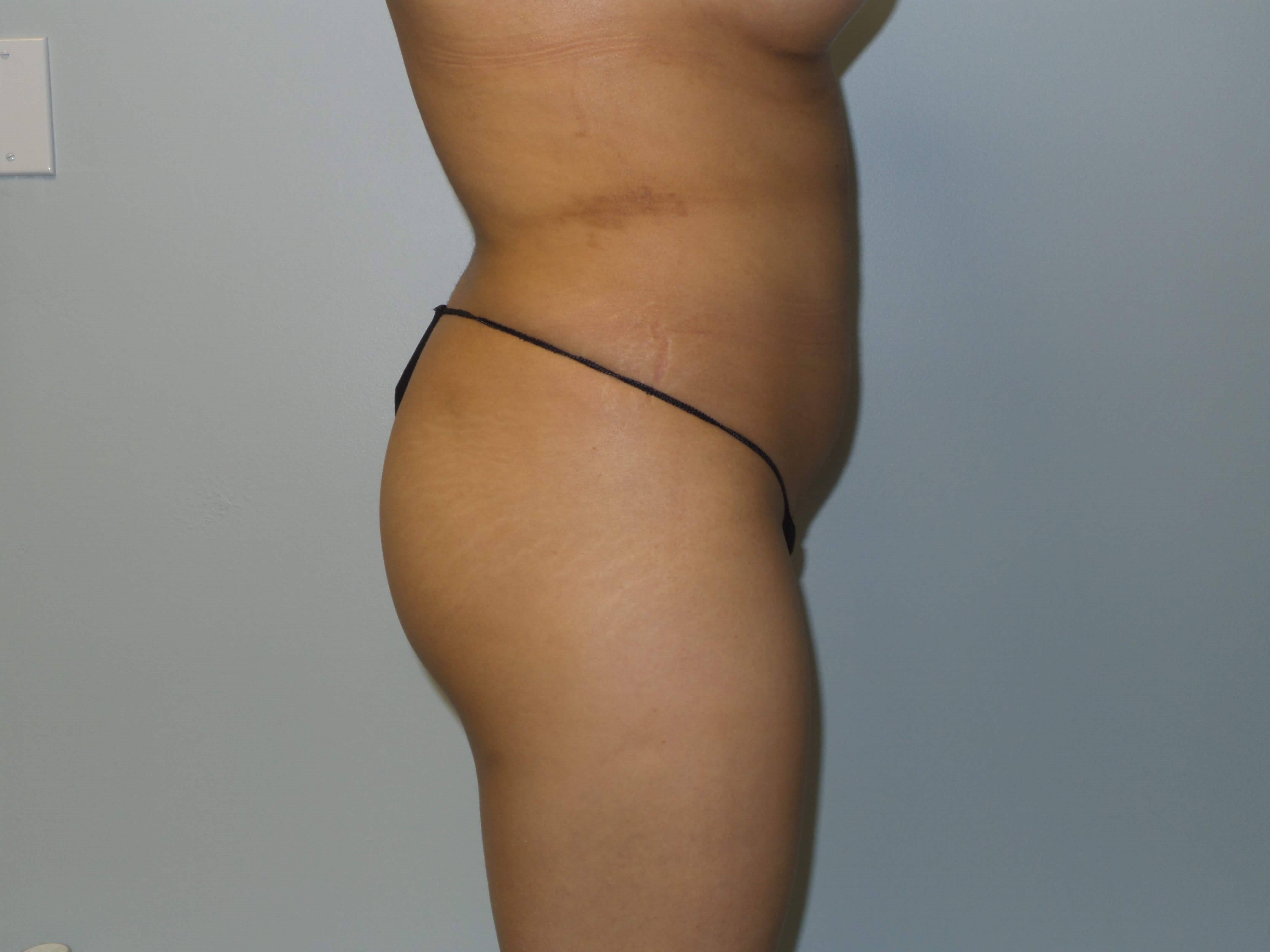 Woman has BBL Before