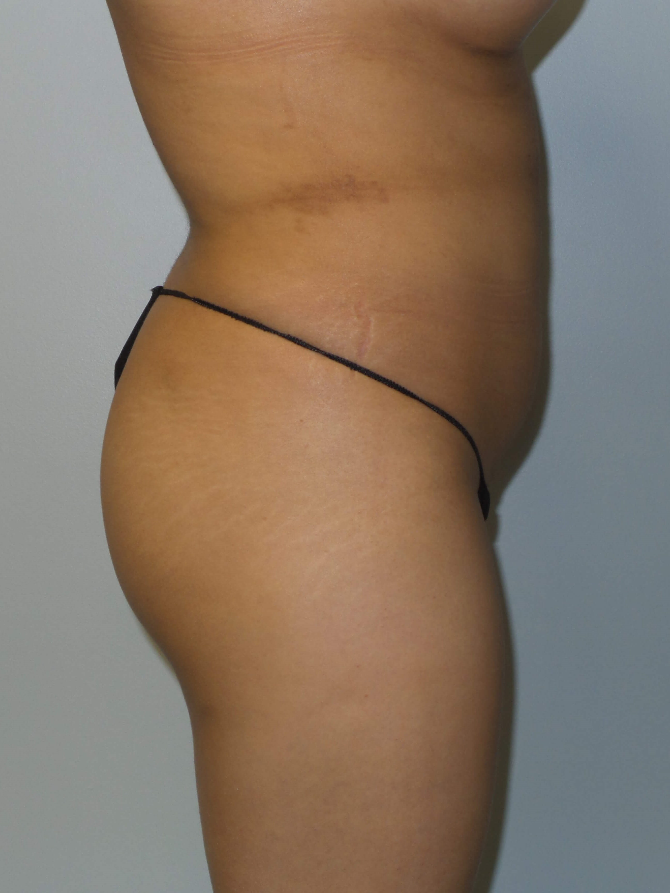 Woman has BBL Before