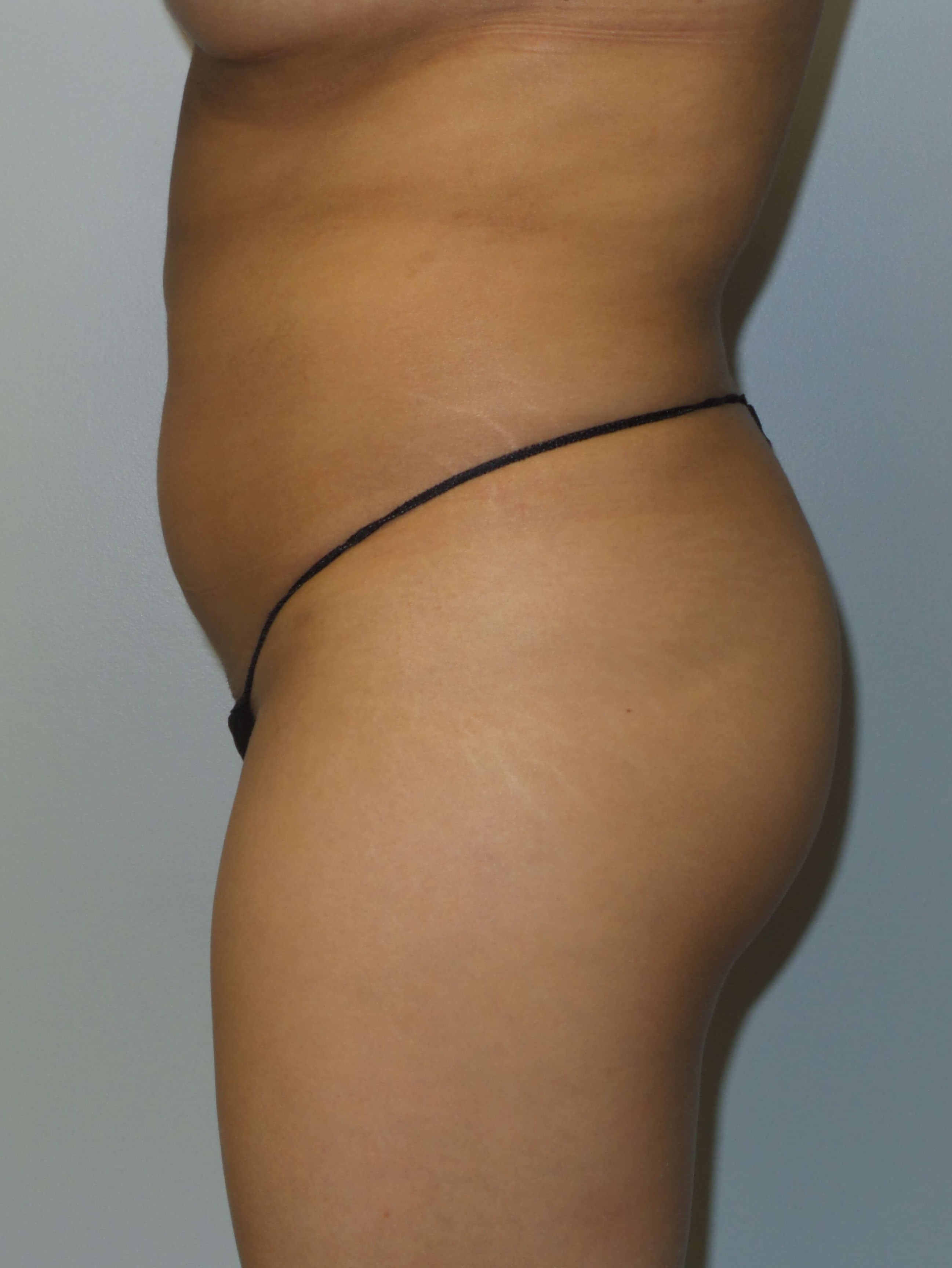 Woman has BBL Before