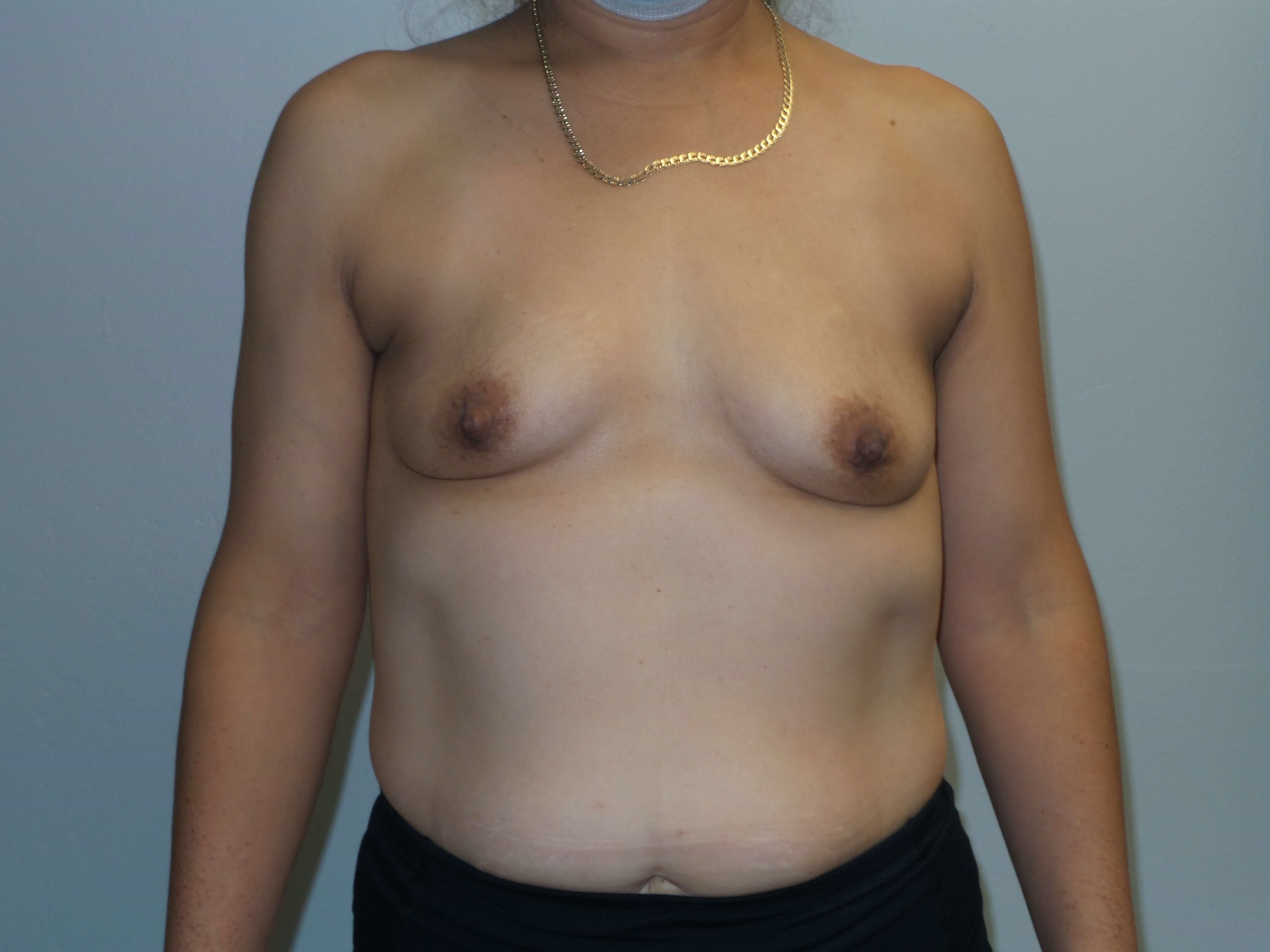 Westlake Woman Has Breast Aug Before