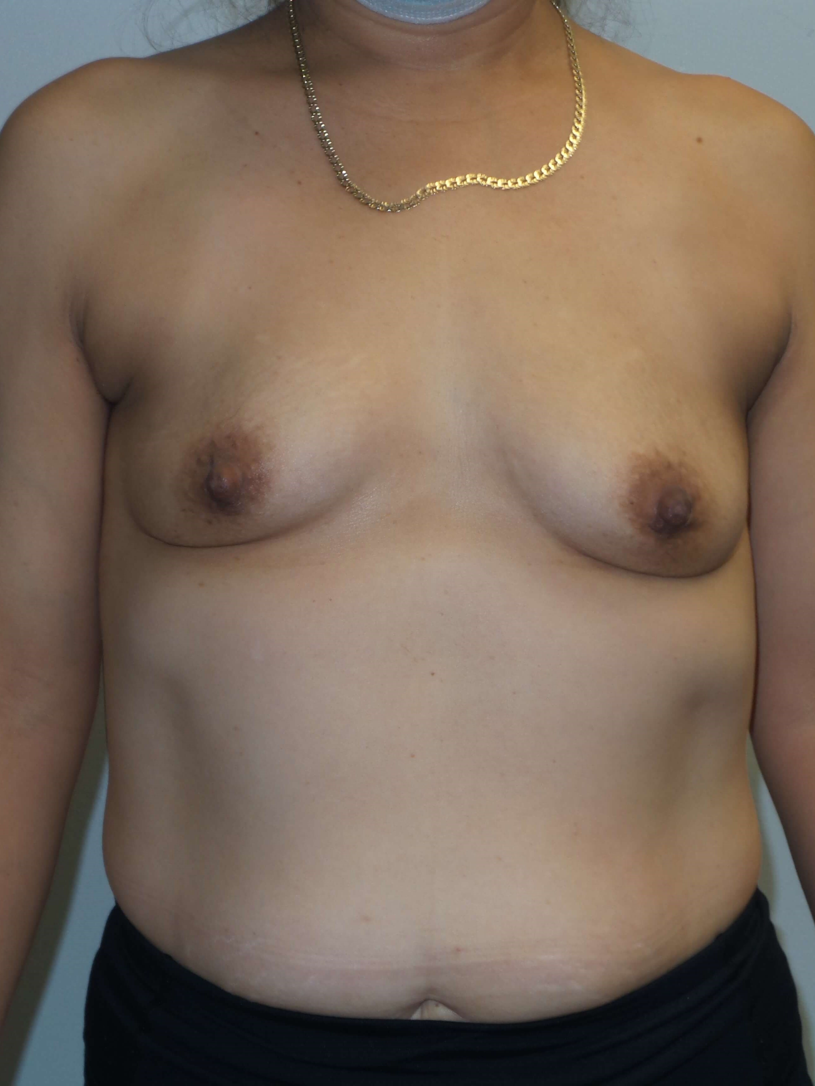 Westlake Woman Has Breast Aug Before