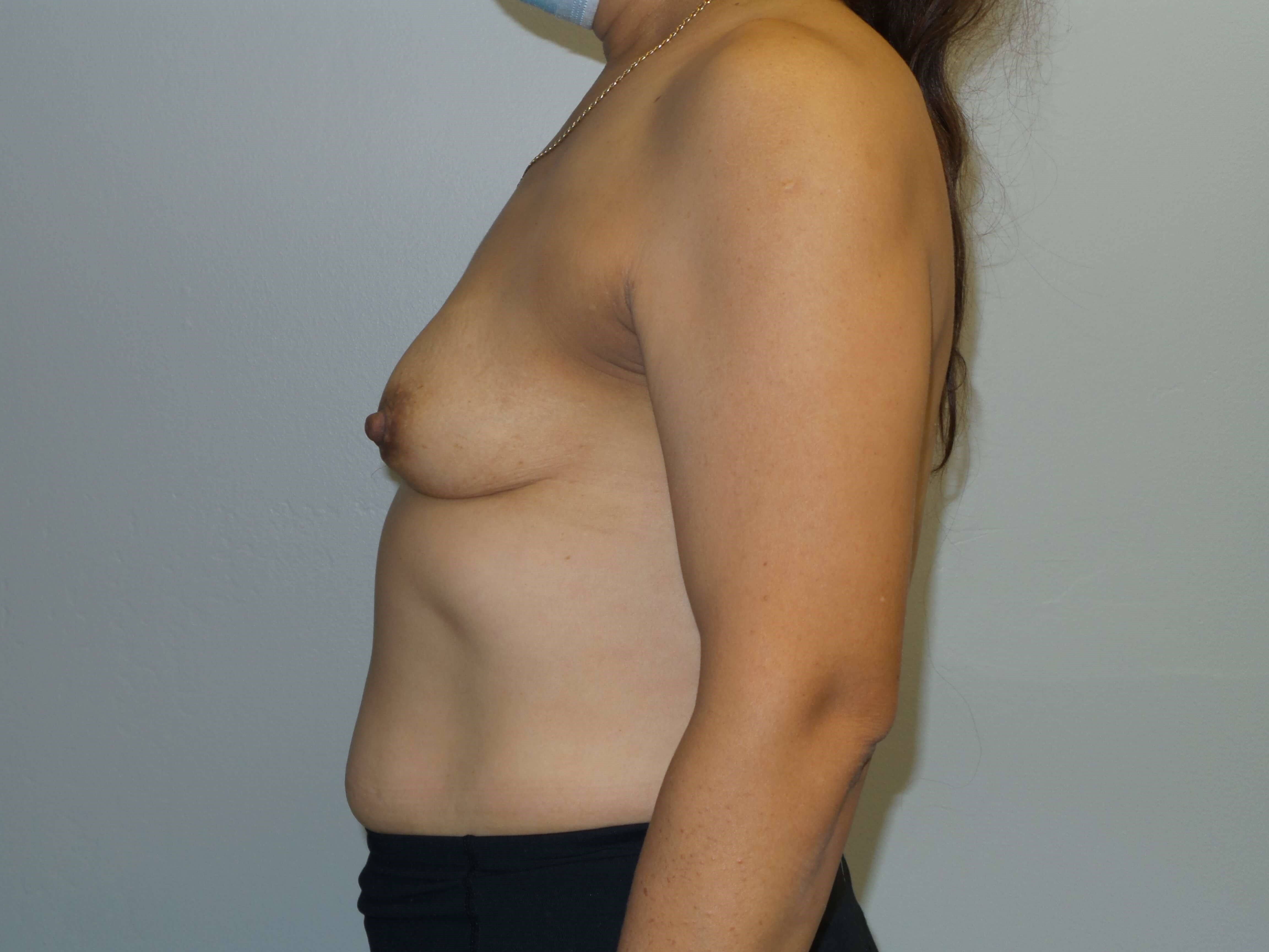 Westlake Woman Has Breast Aug Before