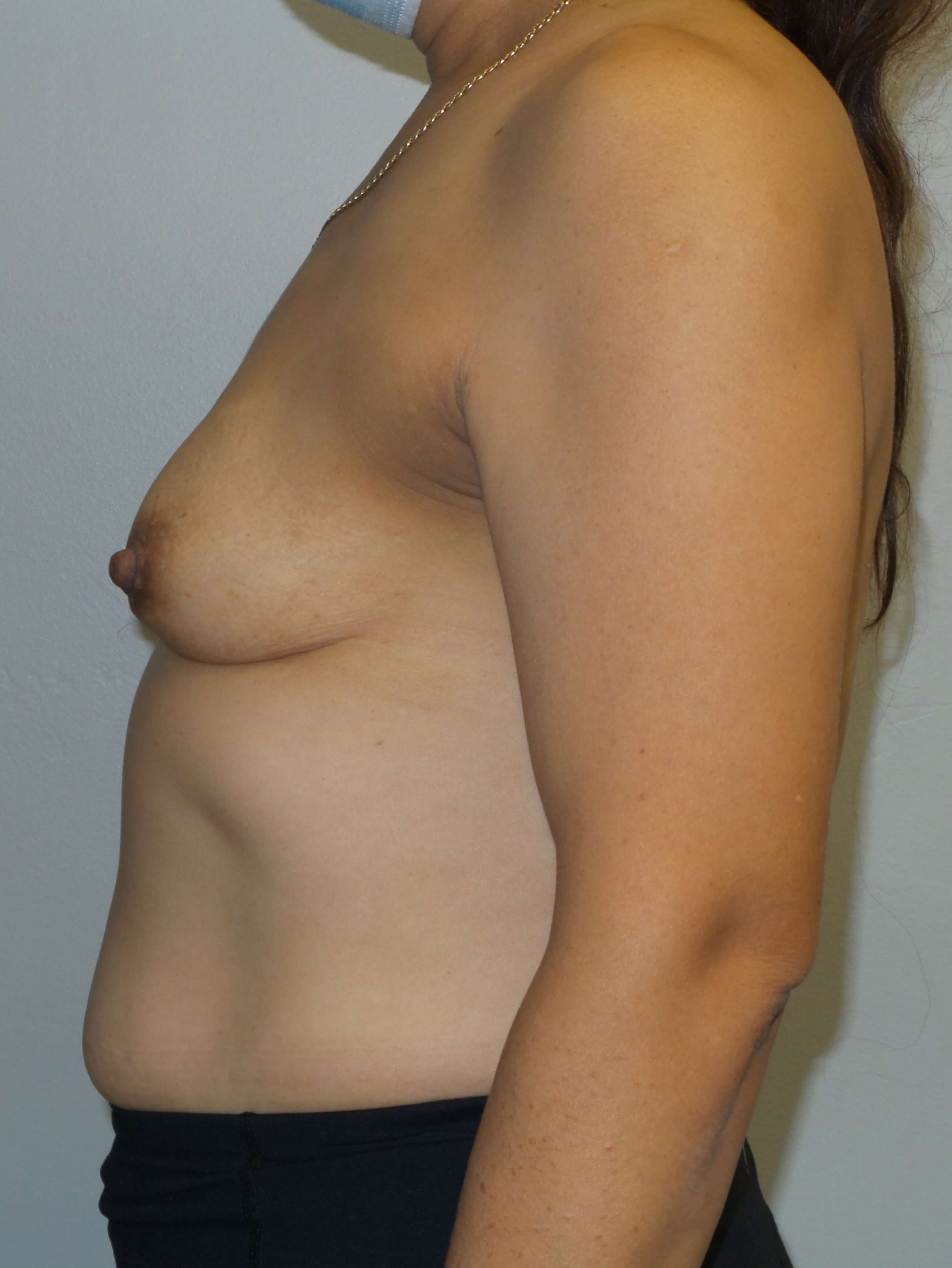 Westlake Woman Has Breast Aug Before