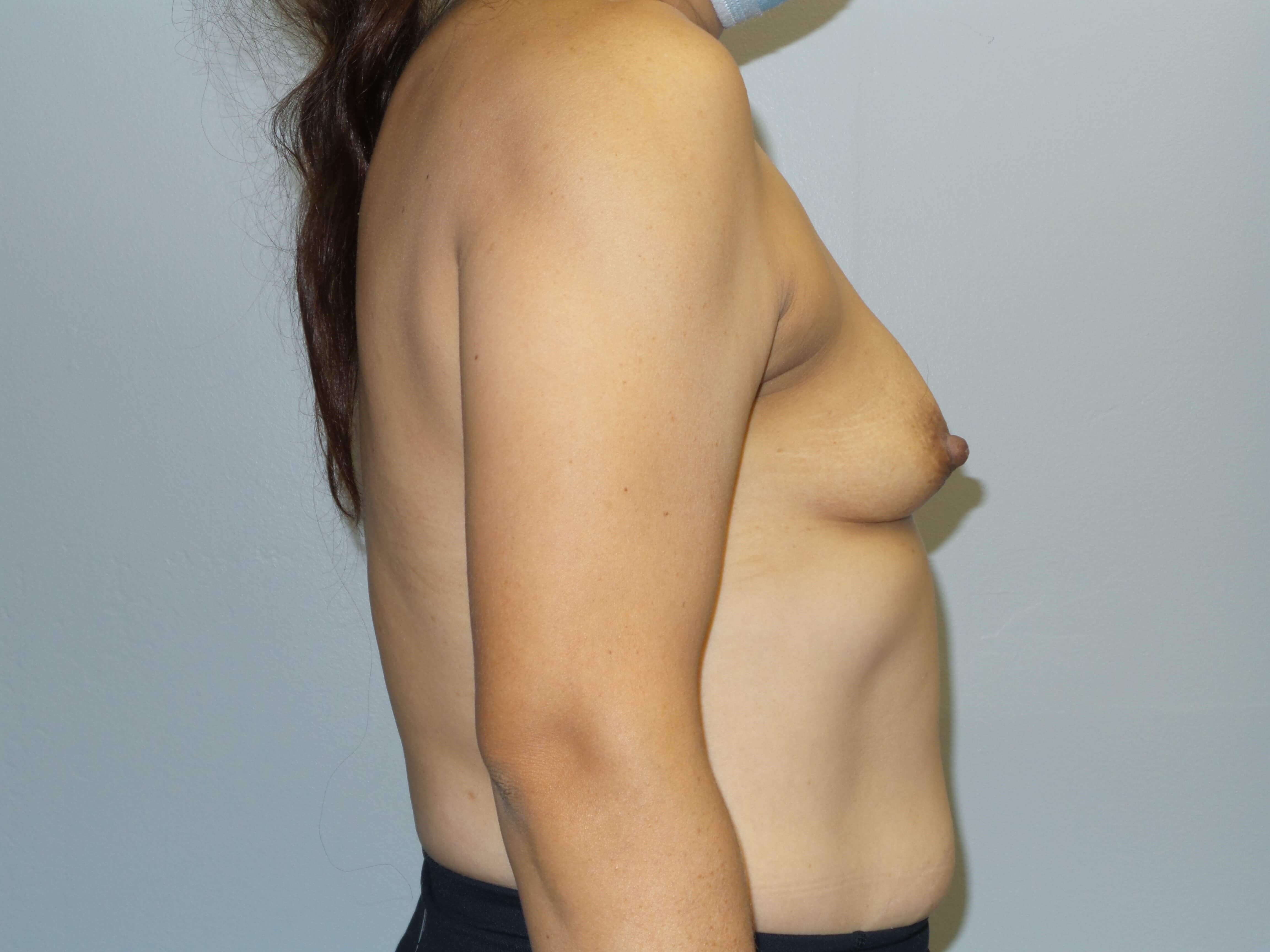 Westlake Woman Has Breast Aug Before