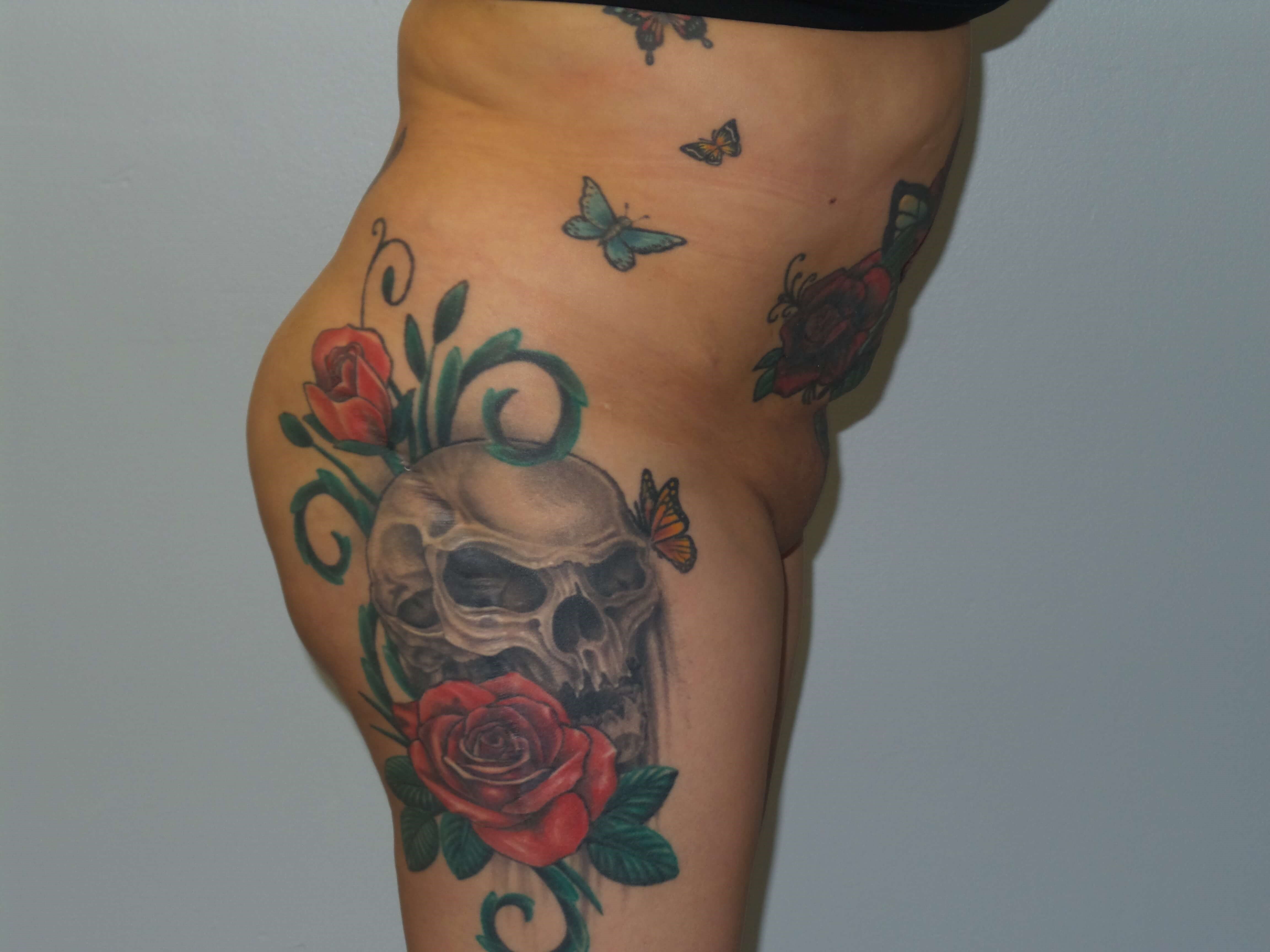 Woman has BBL Butt Lift Before