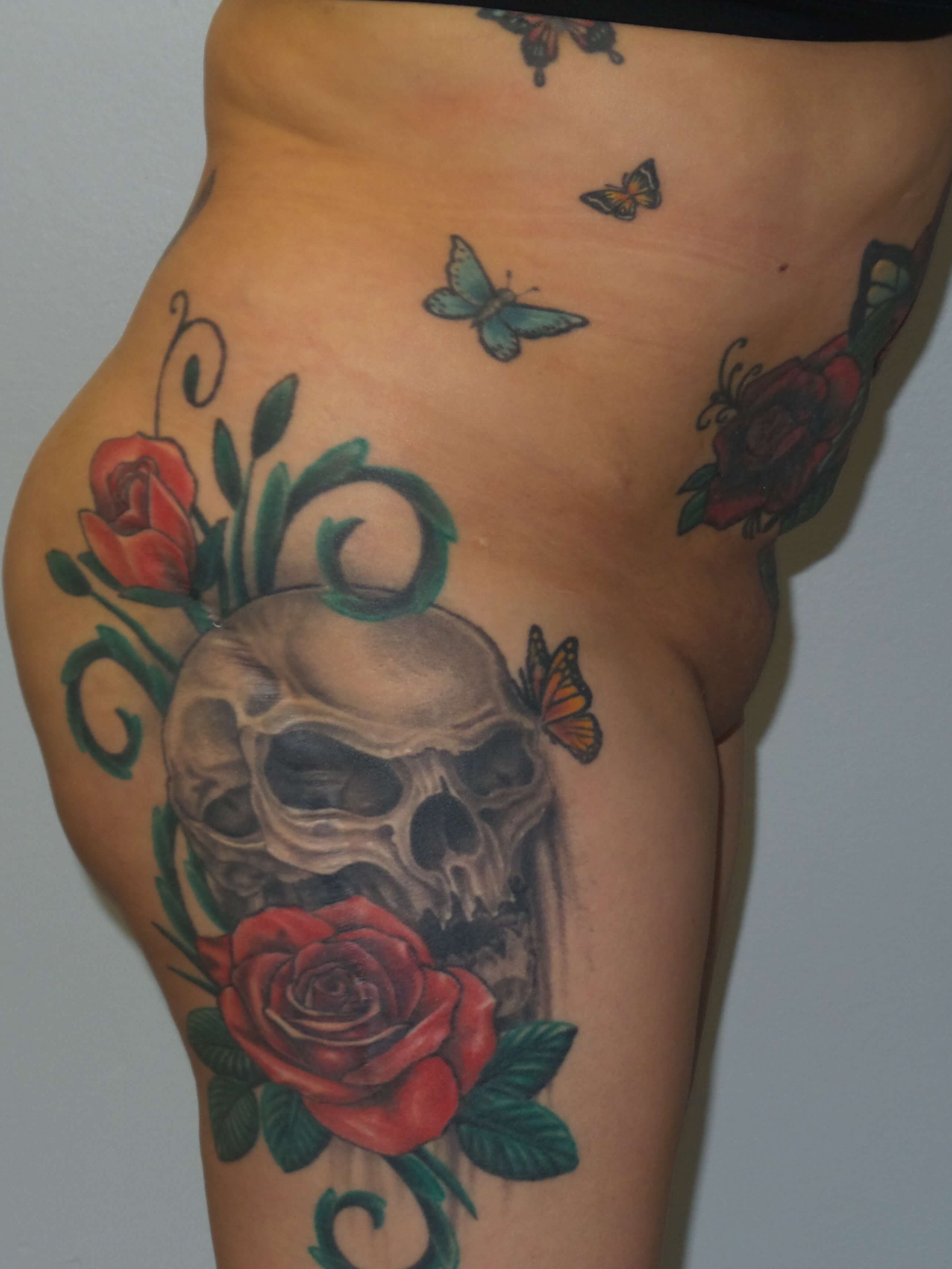 Woman has BBL Butt Lift Before