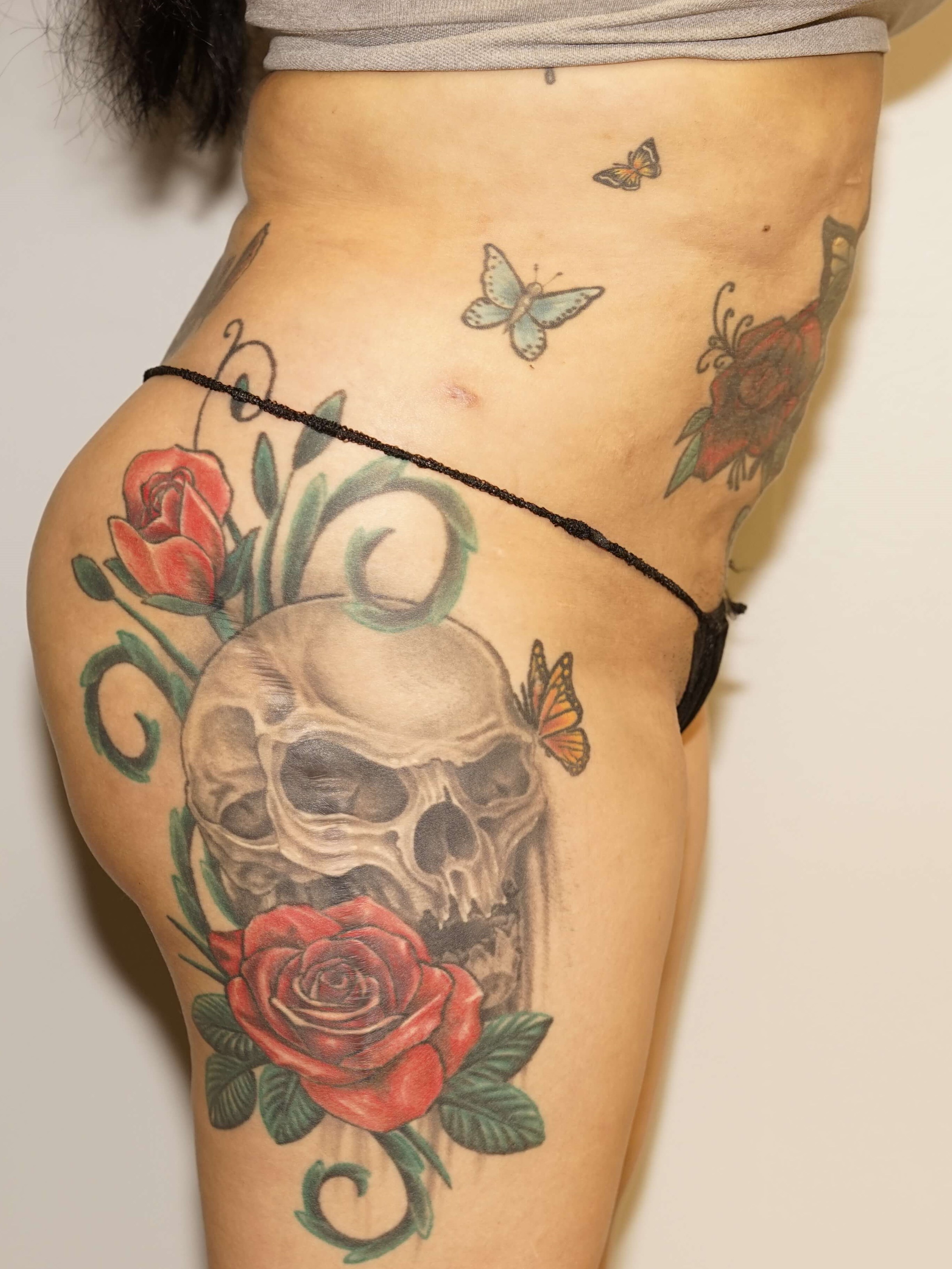 Woman has BBL Butt Lift After