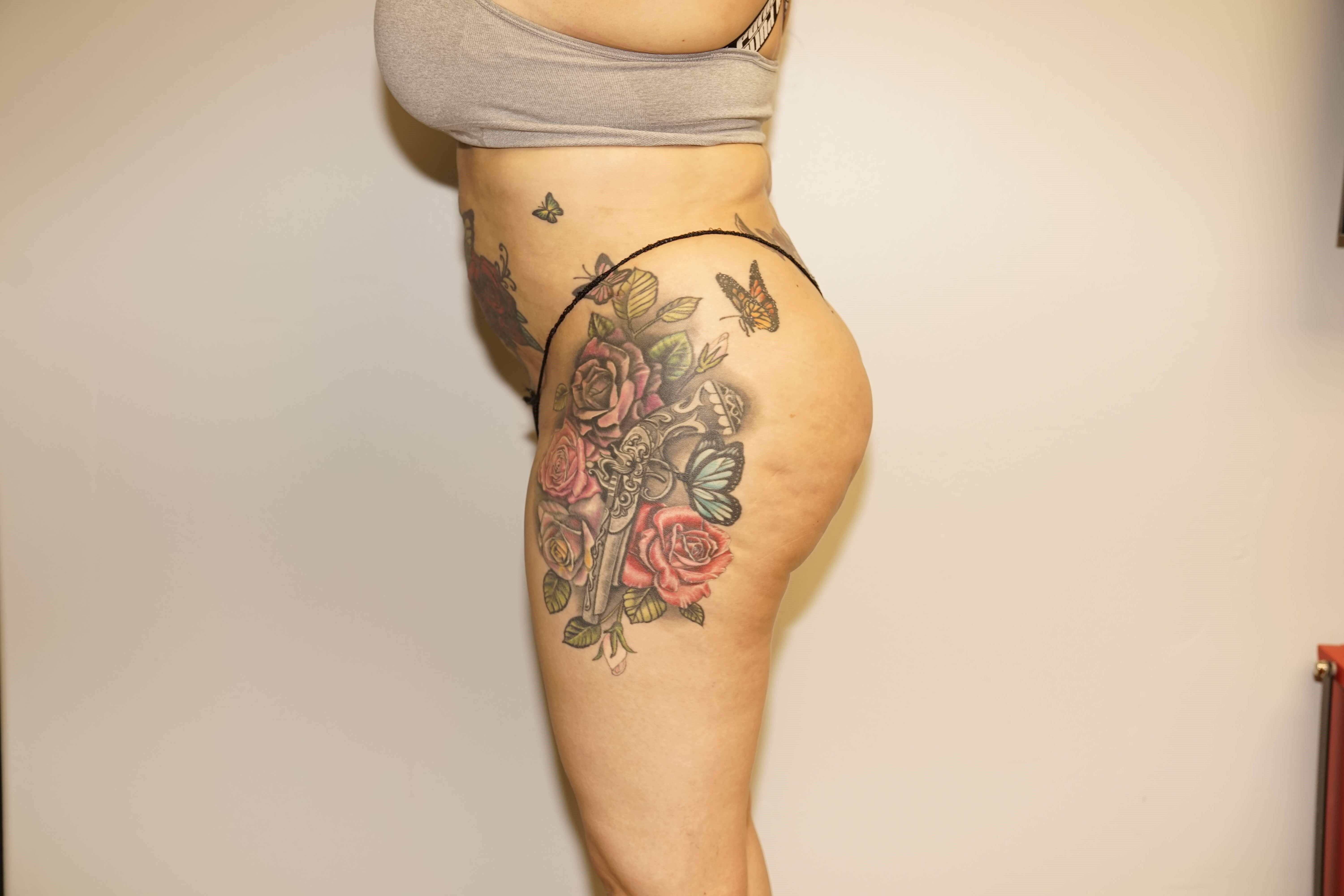 Woman has BBL Butt Lift After