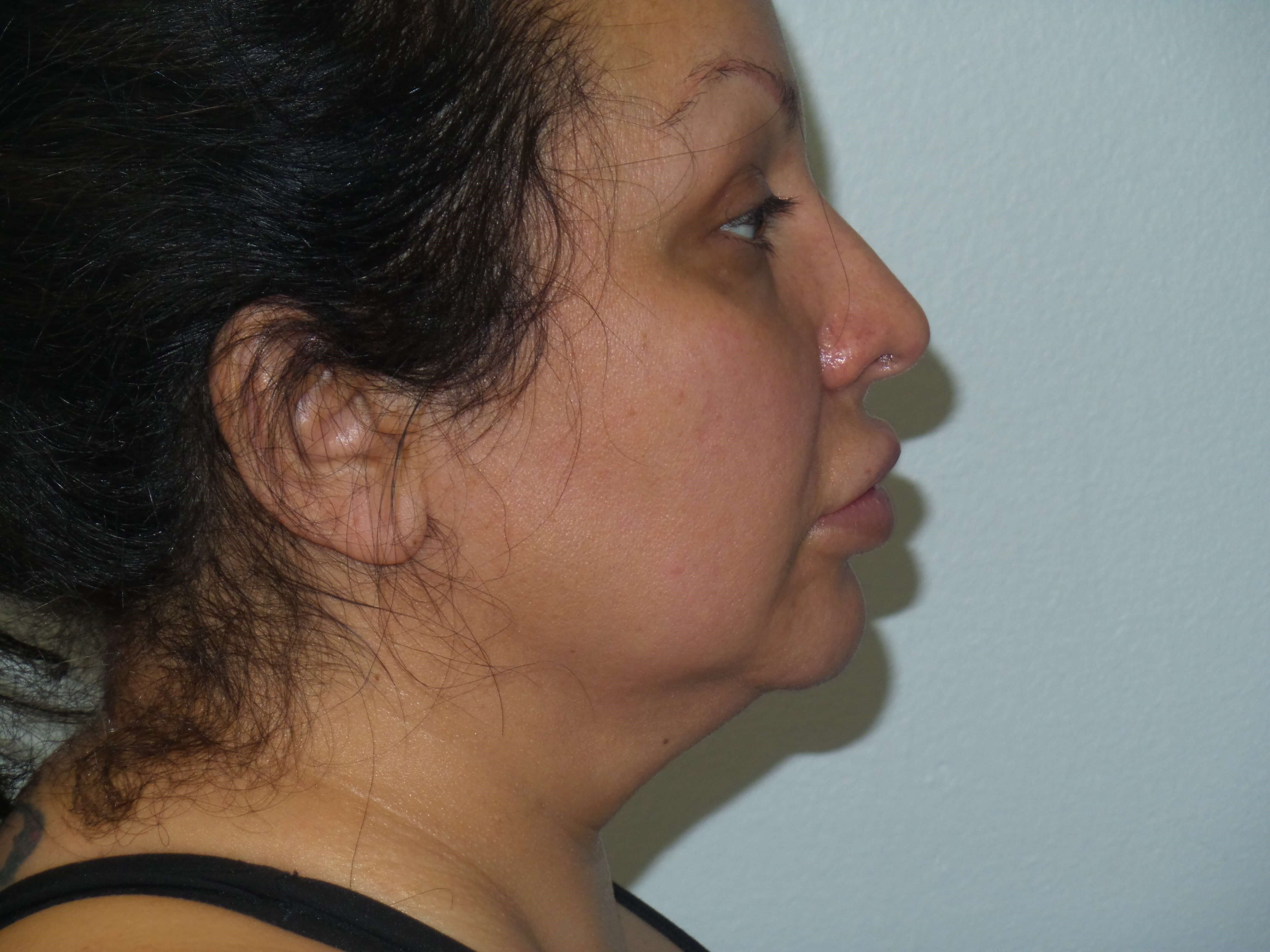 Woman has BBL and Neck Lipo Before