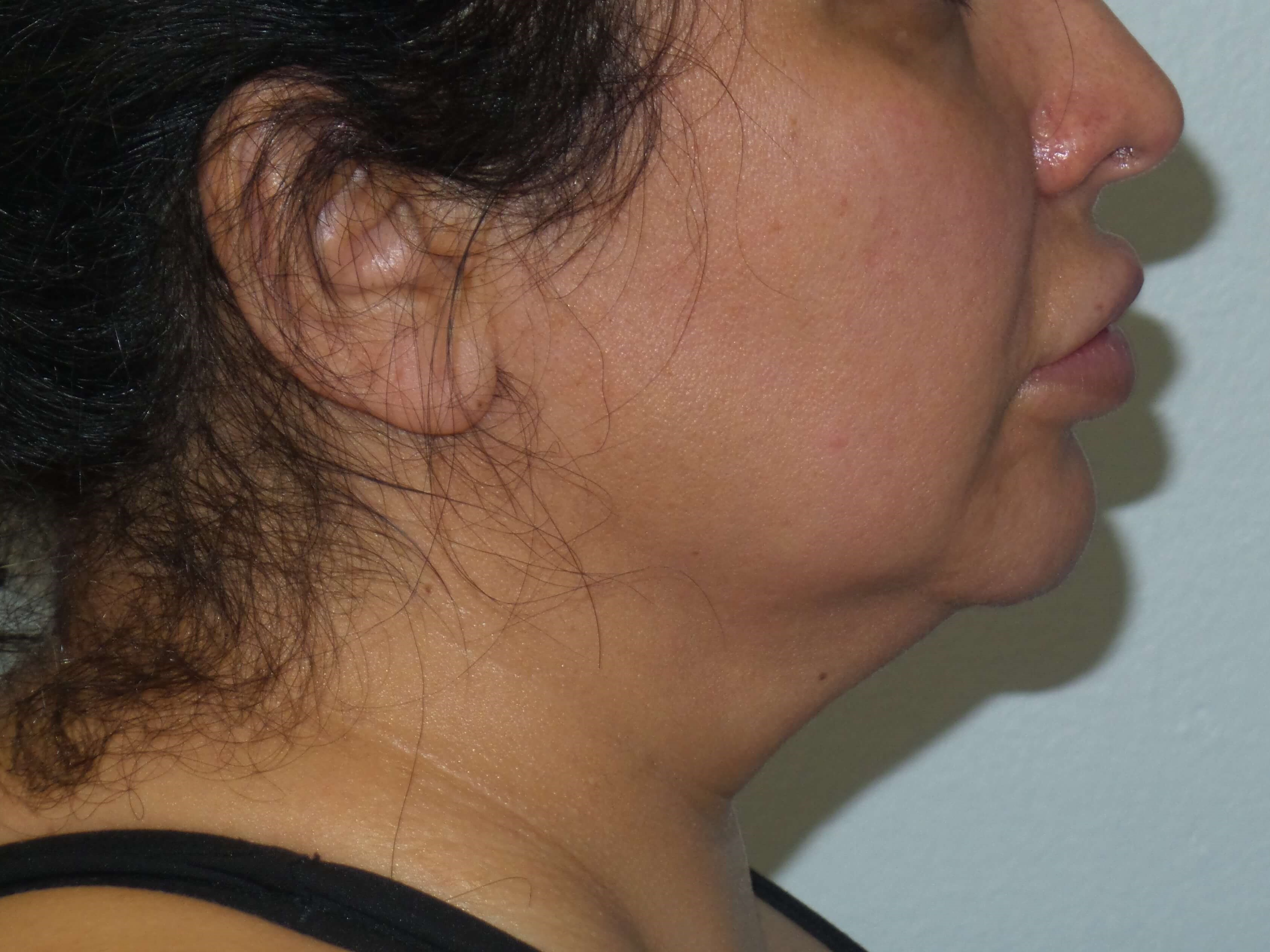 Woman has BBL and Neck Lipo Before