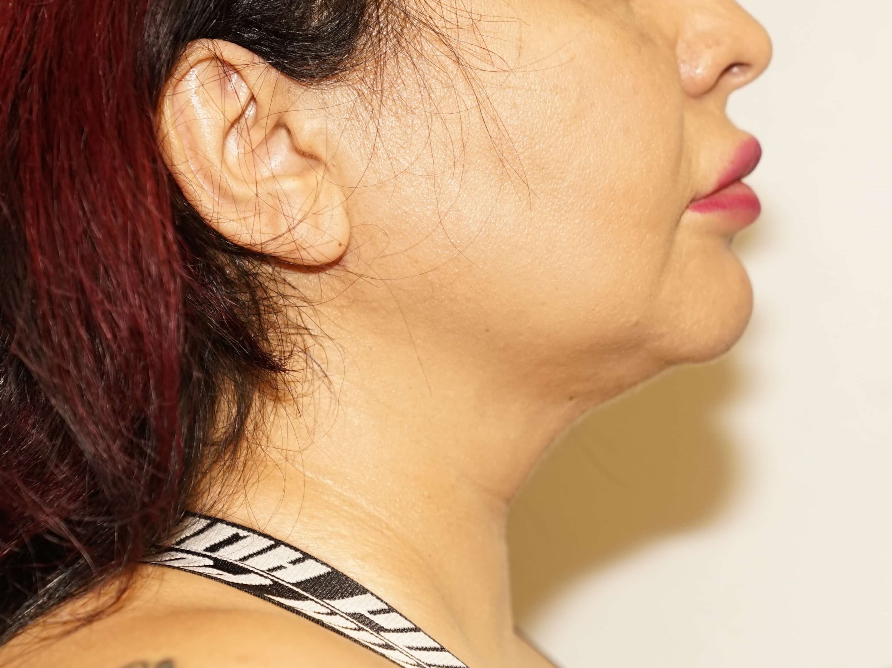 Woman has BBL and Neck Lipo After