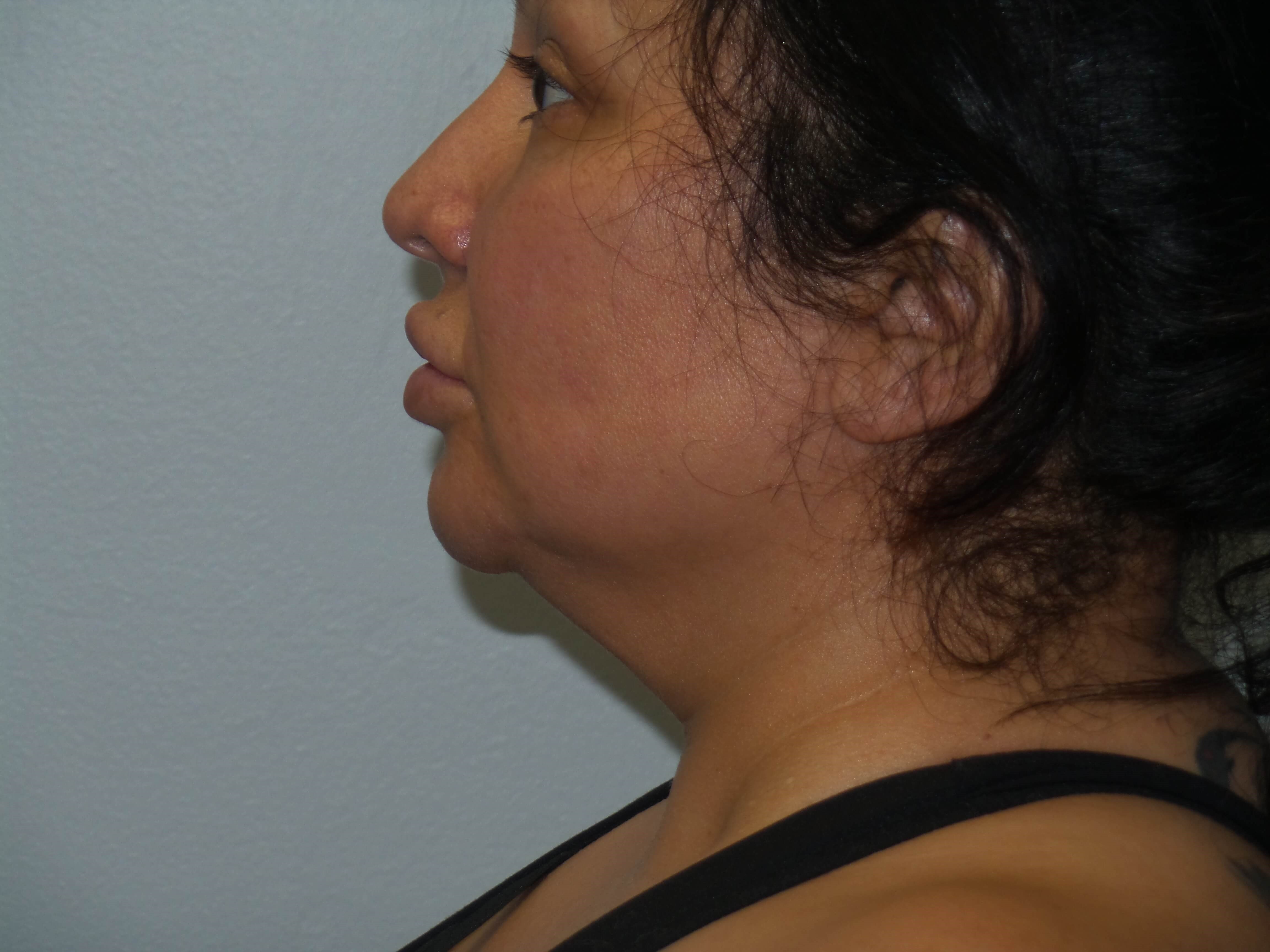 Woman has BBL and Neck Lipo Before