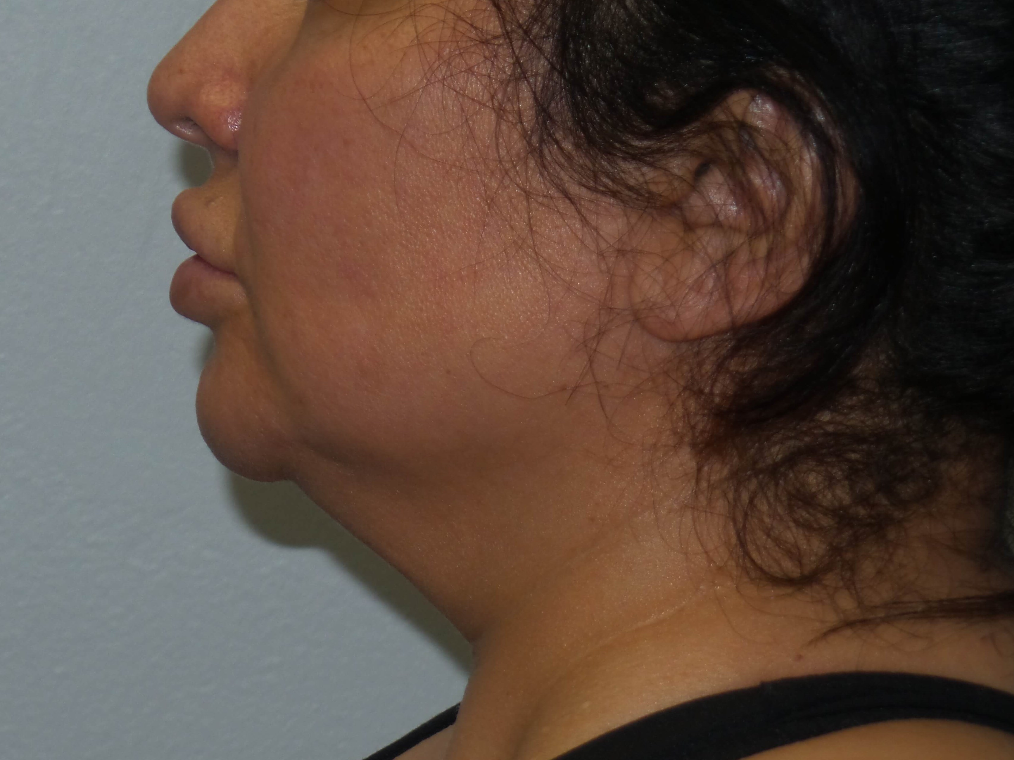 Woman has BBL and Neck Lipo Before