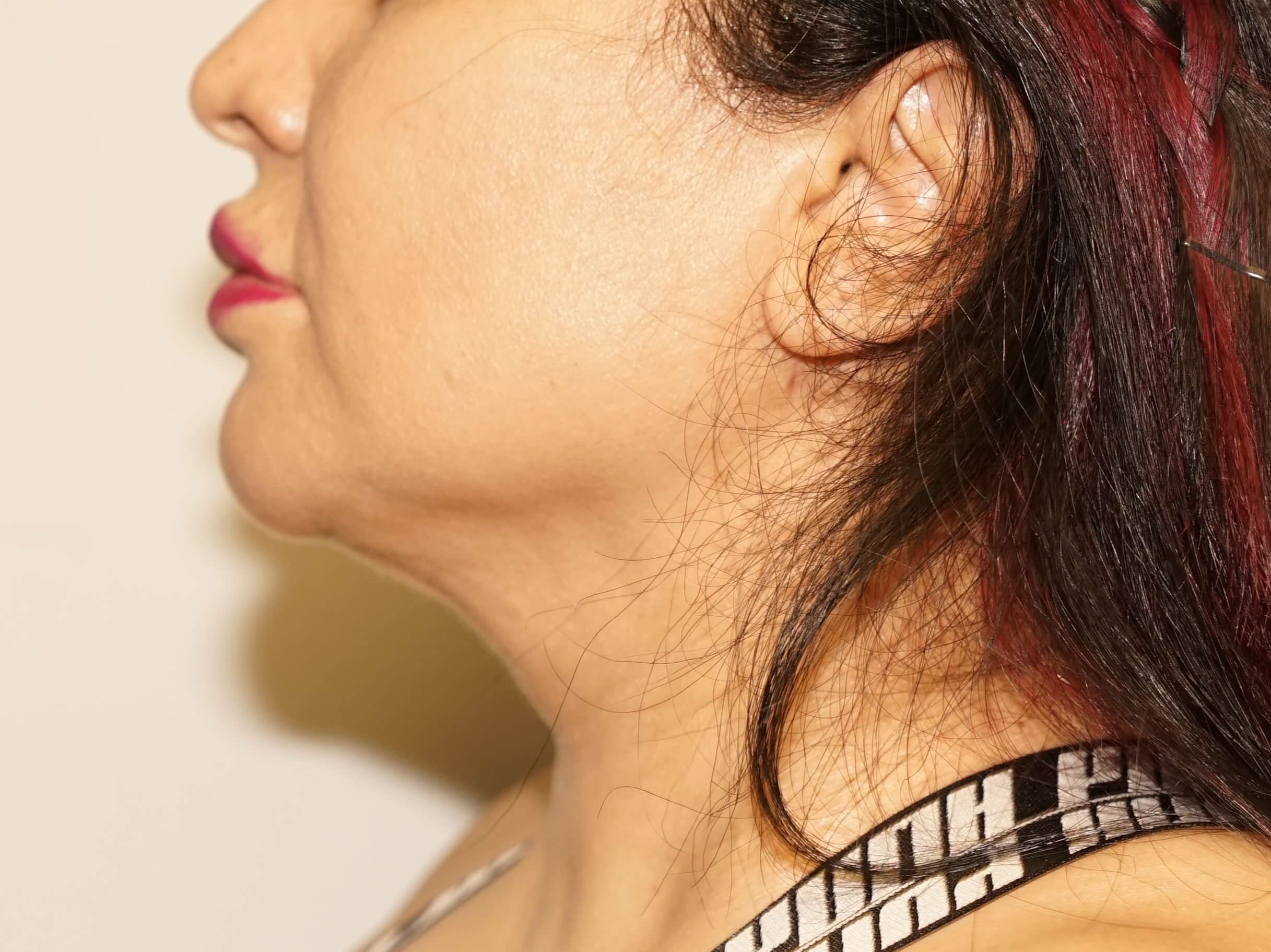 Woman has BBL and Neck Lipo After