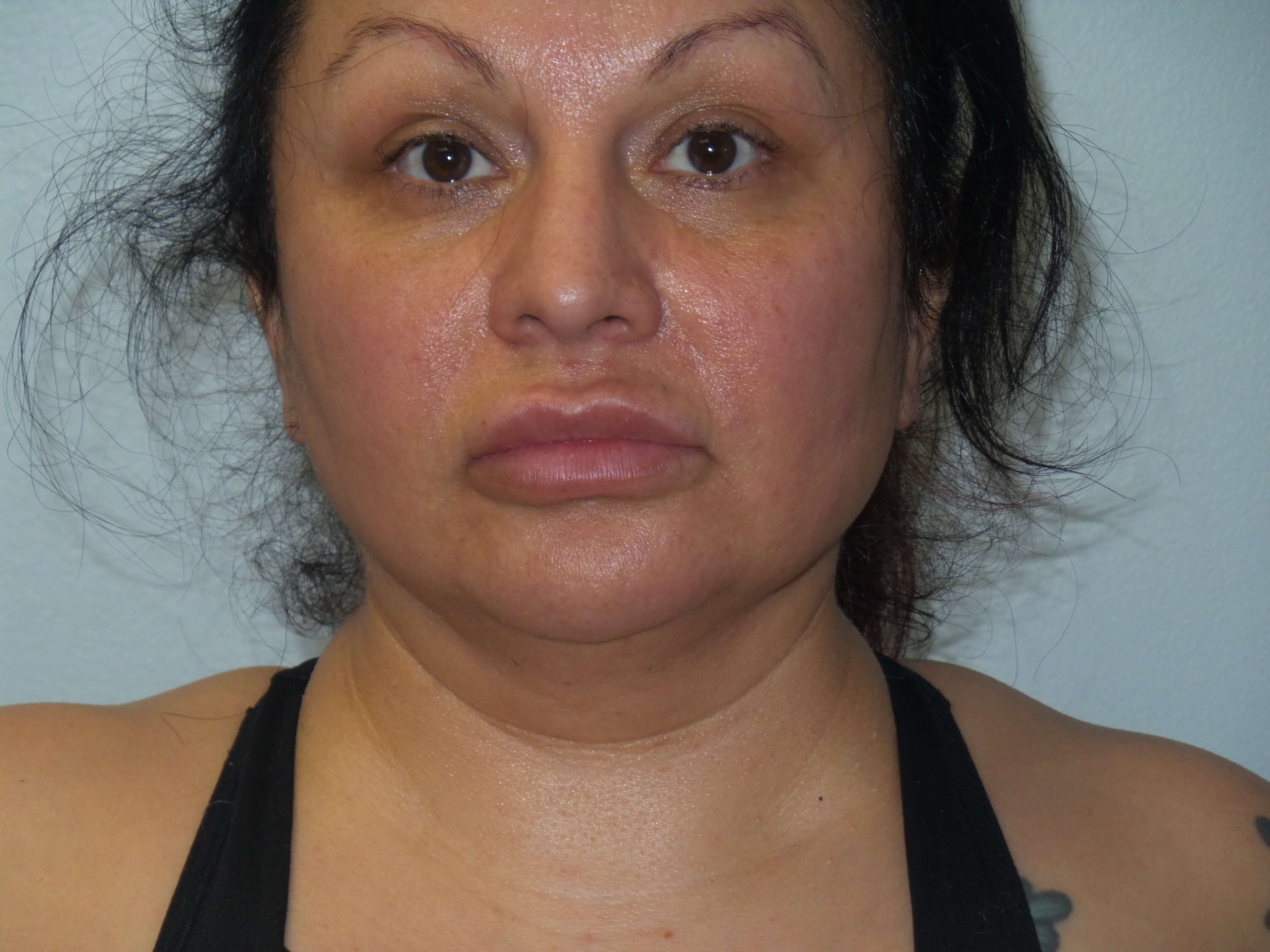 Woman has BBL and Neck Lipo Before
