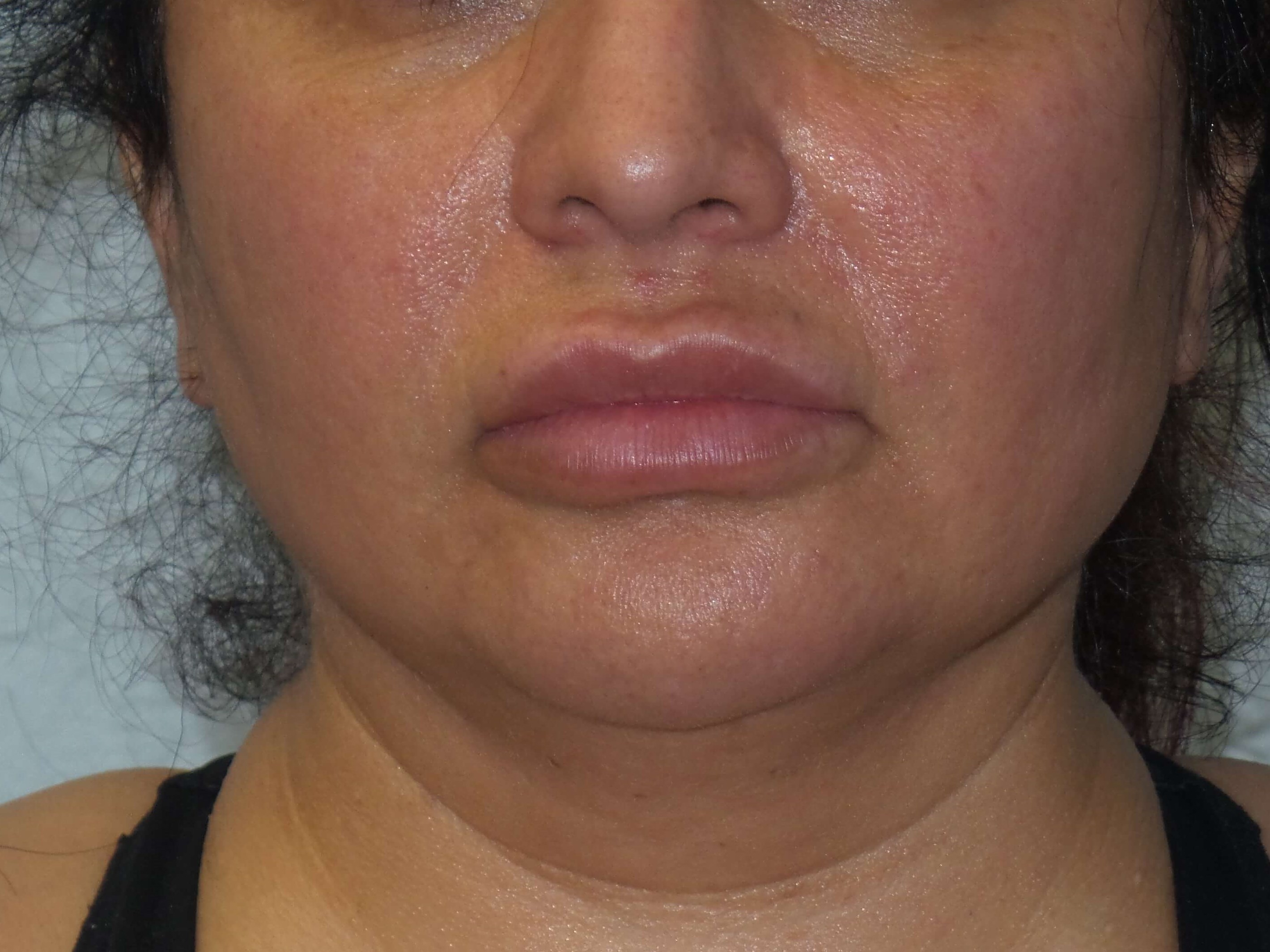 Woman has BBL and Neck Lipo Before