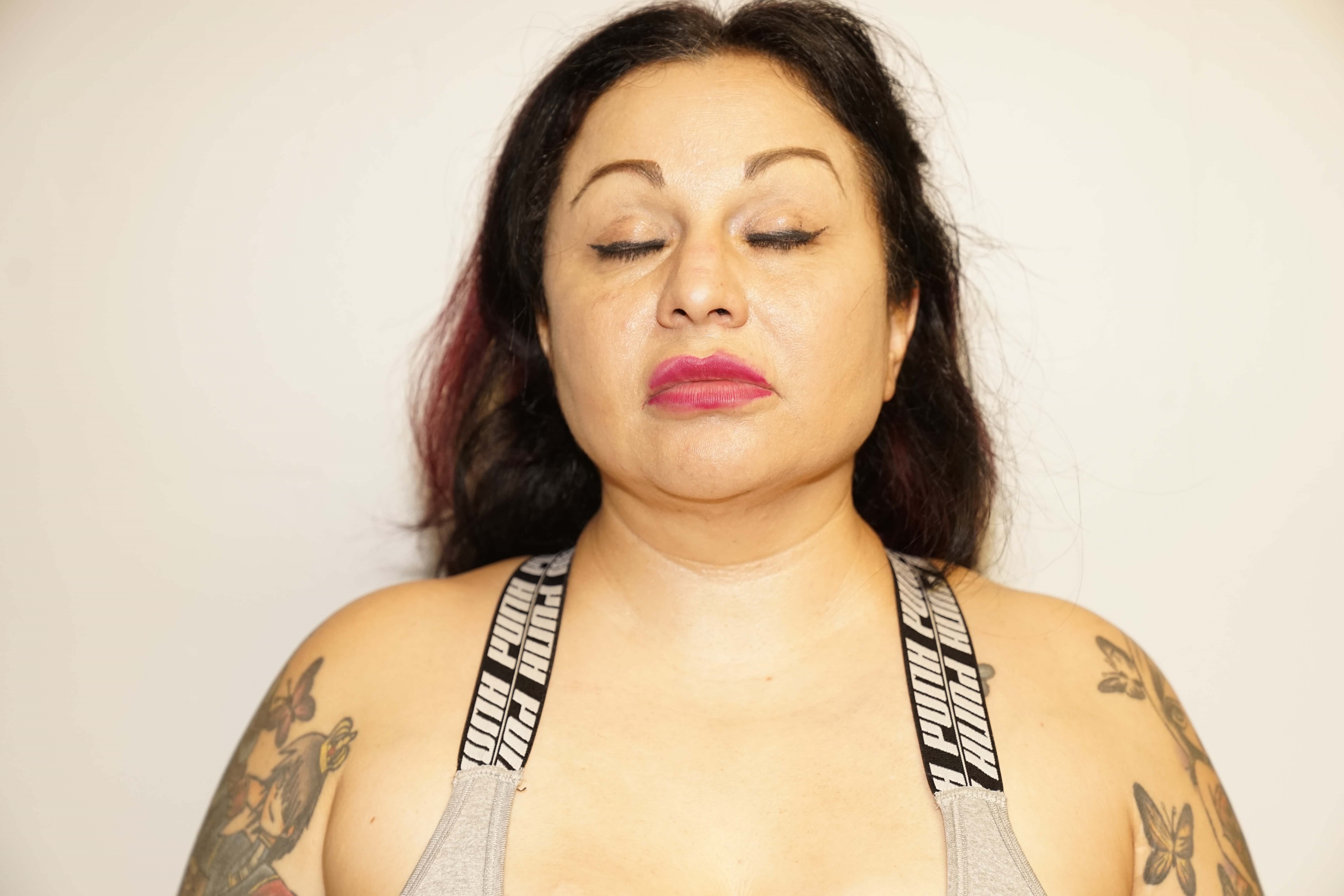 Woman has BBL and Neck Lipo After