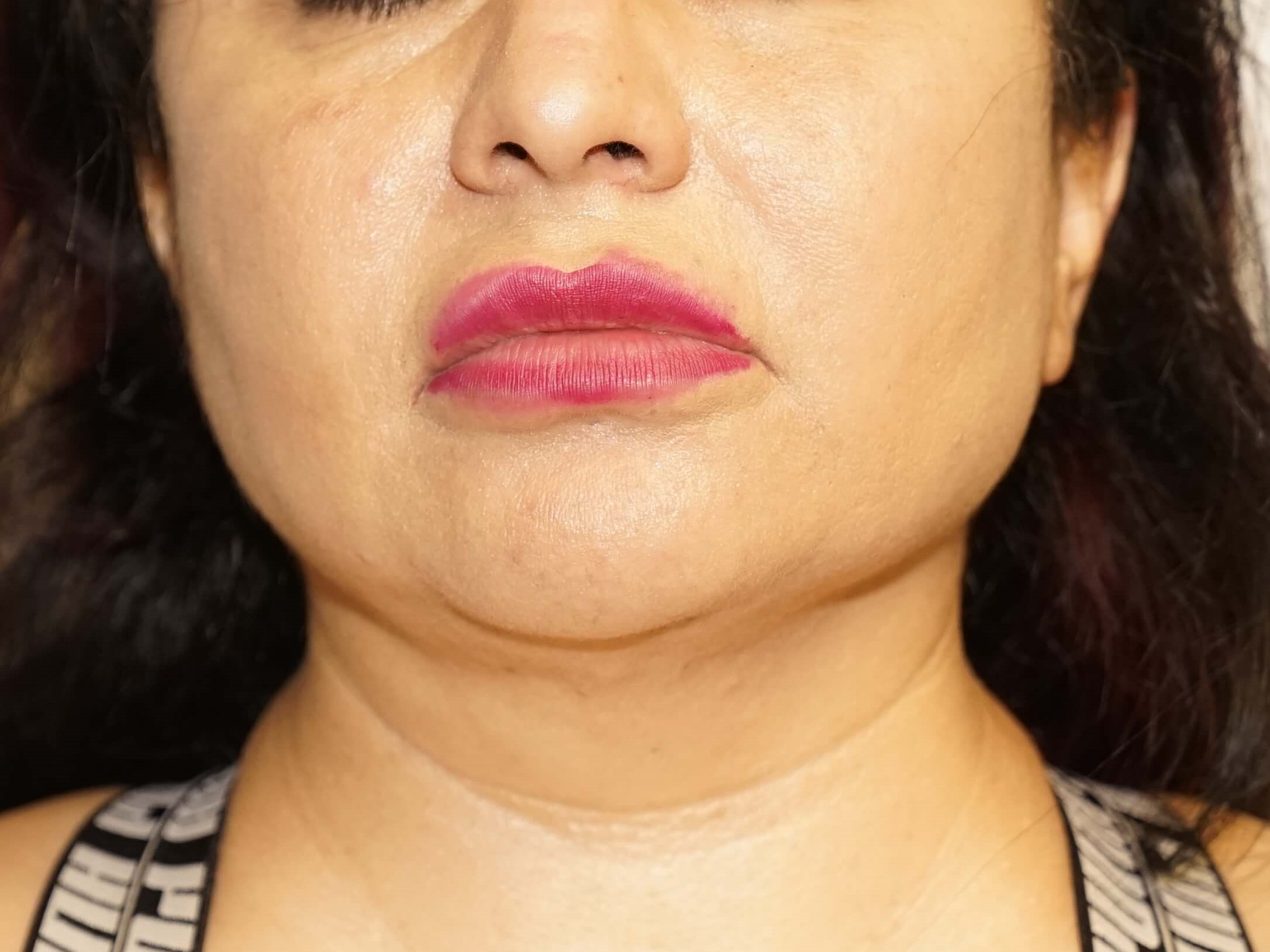 Woman has BBL and Neck Lipo After